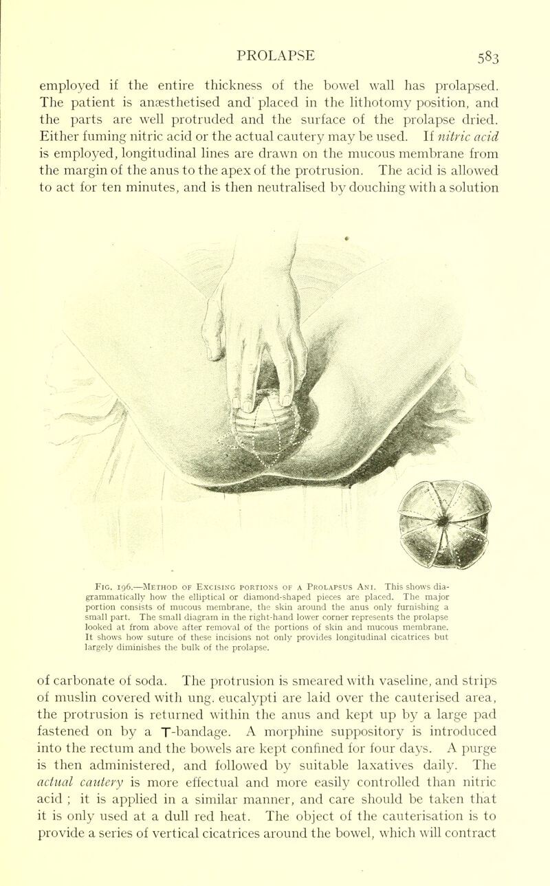 employed if the entire thickness of the bowel wall has prolapsed. The patient is anaesthetised and' placed in the lithotomy position, and the parts are well protruded and the surface of the prolapse dried. Either fuming nitric acid or the actual cautery may be used. If nitric acid is employed, longitudinal lines are drawn on the mucous membrane from the margin of the anus to the apex of the protrusion. The acid is allowed to act for ten minutes, and is then neutralised by douching with a solution » i Fig. 196.—Method of Excising portions of a Prolapsus Ani. This shows dia- grammatically how the elhptical or diamond-shaped pieces are placed. The major portion consists of mucous membrane, tlie skin around the anus only furnishing a small part. The small diagram in tlie right-hand lower corner represents the prolapse looked at from above after removal of the portions of skin and mucous membrane. It shows how suture of these incisions not only provides longitudinal cicatrices but largely diminishes the bulk of the prolapse. of carbonate of soda. The protrusion is smeared with vaseline, and strips of muslin covered with ung. eucalypti are laid over the cauterised area, the protrusion is returned within the anus and kept up by a large pad fastened on by a T-bandage. A morphine suppository is introduced into the rectum and the bowels are kept confined for four days. A purge is then administered, and followed by suitable laxatives daily. The actual cautery is more effectual and more easily controlled than nitric acid ; it is applied in a similar manner, and care should be taken that it is only used at a dull red heat. The object of the cauterisation is to provide a series of vertical cicatrices around the bowel, which will contract