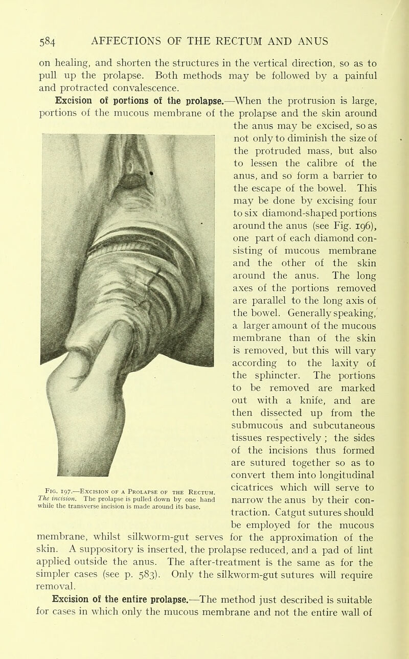 on healing, and shorten the structures in the vertical direction, so as to pull up the prolapse. Both methods may be followed by a painful and protracted convalescence. Excision of portions of the prolapse.—When the protrusion is large, portions of the mucous membrane of the prolapse and the skin around the anus may be excised, so as not only to diminish the size of the protruded mass, but also to lessen the calibre of the anus, and so form a barrier to the escape of the bowel. This may be done by excising four to six diamond-shaped portions around the anus (see Fig. 196), one part of each diamond con- sisting of mucous membrane and the other of the skin around the anus. The long axes of the portions removed are parallel to the long axis of the bowel. Generally speaking, a larger amount of the mucous membrane than of the skin is removed, but this will vary according to the laxity of the sphincter. The portions to be removed are marked out with a knife, and are then dissected up from the submucous and subcutaneous tissues respectively ; the sides of the incisions thus formed are sutured together so as to convert them into longitudinal Fig. 197.-Exc1s.ON OP A Prolapse o. the Rectum. CatriceS which will SCrVe tO The incision. The prolapse is pulled down by one hand narrOW the anUS by their COU- while the transverse incision is made around its base. . „ traction. Catgut sutures should be employed for the mucous membrane, whilst silkworm-gut serves for the approximation of the skin. A suppository is inserted, the prolapse reduced, and a pad of lint applied outside the anus. The after-treatment is the same as for the simpler cases (see p. 583). Only the silkworm-gut sutures will require removal. Excision of the entire prolapse,—^The method just described is suitable for cases in which only the mucous membrane and not the entire wall of