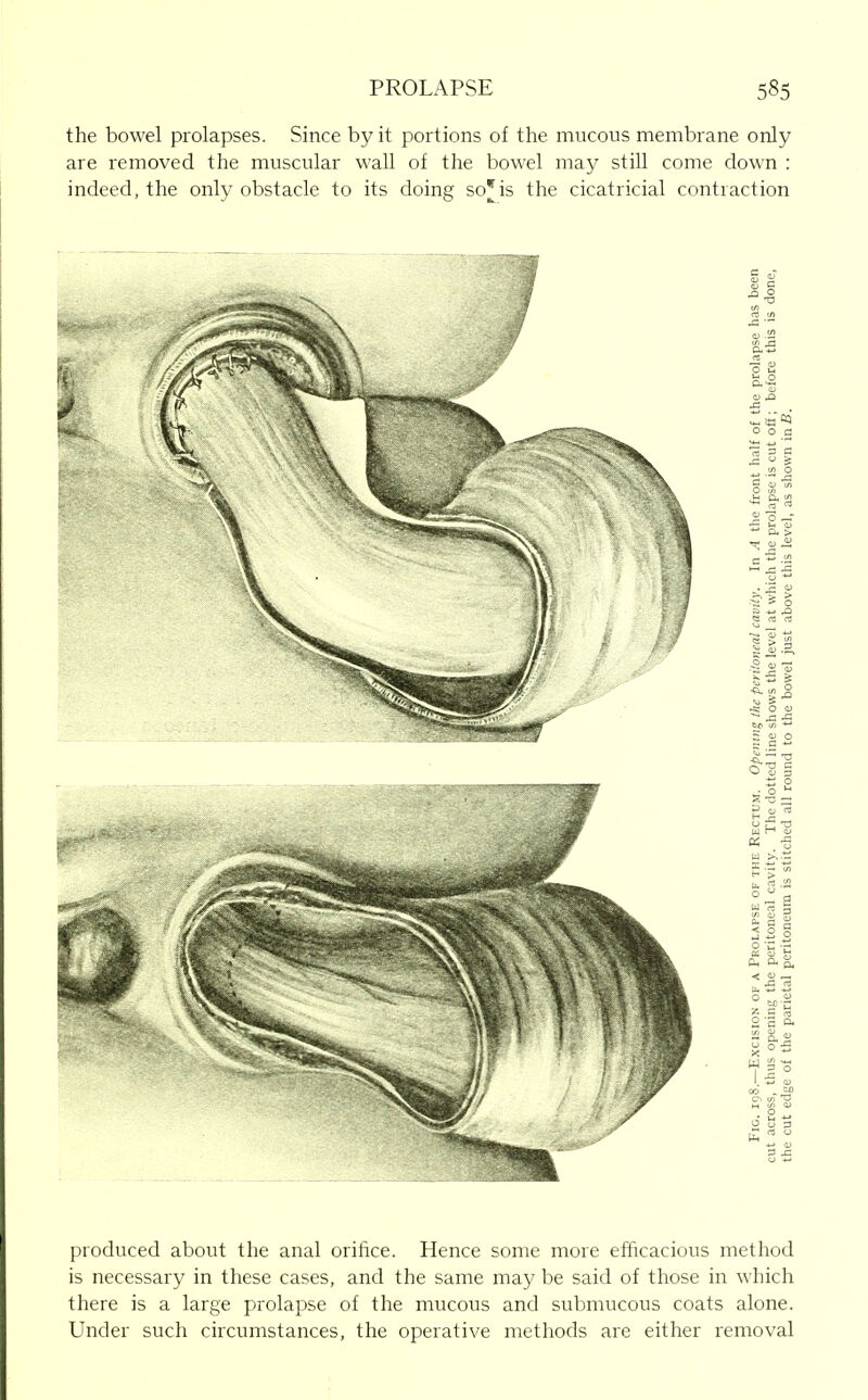 the bowel prolapses. Since by it portions of the mucous membrane only are removed the muscular wall of the bowel may still come down : indeed, the only obstacle to its doing so'is the cicatricial contraction produced about the anal orifice. Hence some more efficacious method is necessary in these cases, and the same may be said of those in which there is a large prolapse of the mucous and submucous coats alone. Under such circumstances, the operative methods are either removal