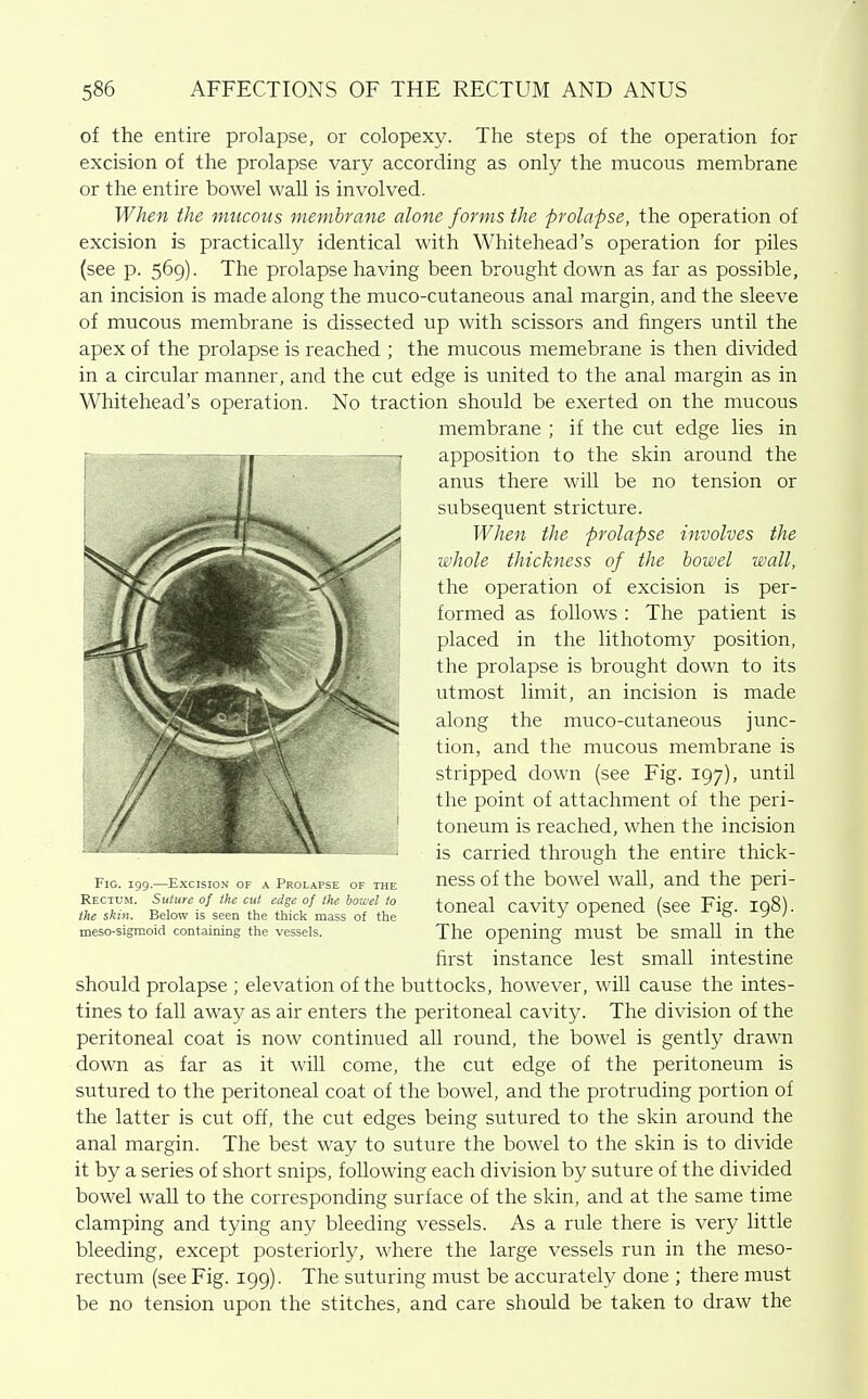 of the entire prolapse, or colopexy. The steps of the operation for excision of the prolapse vary according as only the mucous membrane or the entire bowel wall is involved. When the mucous membrane alone forms the prolapse, the operation of excision is practically identical with Whitehead's operation for piles (see p. 569). The prolapse having been brought down as far as possible, an incision is made along the muco-cutaneous anal margin, and the sleeve of mucous membrane is dissected up with scissors and fingers until the apex of the prolapse is reached ; the mucous memebrane is then divided in a circular manner, and the cut edge is united to the anal margin as in Whitehead's operation. No traction should be exerted on the mucous membrane ; if the cut edge lies in apposition to the skin around the anus there will be no tension or subsequent stricture. When the prolapse involves the whole thickness of the bowel wall, the operation of excision is per- formed as follows : The patient is placed in the lithotomy position, the prolapse is brought down to its utmost limit, an incision is made along the muco-cutaneous junc- tion, and the mucous membrane is stripped down (see Fig. 197), until the point of attachment of the peri- toneum is reached, when the incision is carried through the entire thick- ness of the bowel wall, and the peri- toneal cavity opened (see Fig. 198). The opening must be small in the first instance lest small intestine should prolapse ; elevation of the buttocks, however, will cause the intes- tines to fall away as air enters the peritoneal cavity. The division of the peritoneal coat is now continued all round, the bowel is gently drawn down as far as it will come, the cut edge of the peritoneum is sutured to the peritoneal coat of the bowel, and the protruding portion of the latter is cut off, the cut edges being sutured to the skin around the anal margin. The best way to suture the bowel to the skin is to divide it by a series of short snips, following each division by suture of the divided bowel waU to the corresponding surface of the skin, and at the same time clamping and tying any bleeding vessels. As a rule there is very little bleeding, except posteriorly, where the large vessels run in the meso- rectum (see Fig. 199). The suturing must be accurately done ; there must be no tension upon the stitches, and care should be taken to draw the Fig. I'i'j.—lixciiioN oi- a I'KuLArsE of the Rectum. Siilitre of the cut edge of the bowel to the skin. Below is seen the thick mass of the meso-sigmoid containing the vessels.