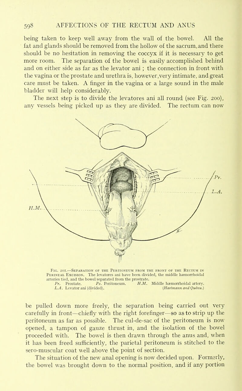 being taken to keep well away from the wall of the bowel. All the fat and glands should be removed from the hollow of the sacrum, and there should be no hesitation in removing the coccyx if it is necessary to get more room. The separation of the bowel is easily accomplished behind and on either side as far as the levator ani ; the connection in front with the vagina or the prostate and urethra is, however,very intimate, and great care must be taken. A finger in the vagina or a large sound in the male bladder will help considerably. The next step is to divide the levatores ani all round (see Fig. 200), any vessels being picked up as they are divided. The rectum can now Fig. 201.—Separation of the Peritoneum from the front of the Rectum in Perineal Excision. The levatores ani have been divided, the middle hasmorrhoidal arteries tied, and the bowel separated from the prostrate. Pr. Prostate. Pe. Peritoneum. H.M. Middle haemorrhoidal artery. L.A. Levator ani (divided). (Harlmann and Quenu.) be pulled down more freely, the separation being carried out very carefully in front—chiefly with the right forefinger—so as to strip up the peritoneum as far as possible. The cul-de-sac of the peritoneum is now opened, a tampon of gauze thrust in, and the isolation of the bowel proceeded with. The bowel is then dra\\'n through the anus and, when it has been freed sufficiently, the parietal peritoneum is stitched to the sero-muscular coat well above the point of section. The situation of the new anal opening is now decided upon. Formerly, the bowel was brought down to the normal position, and if any portion