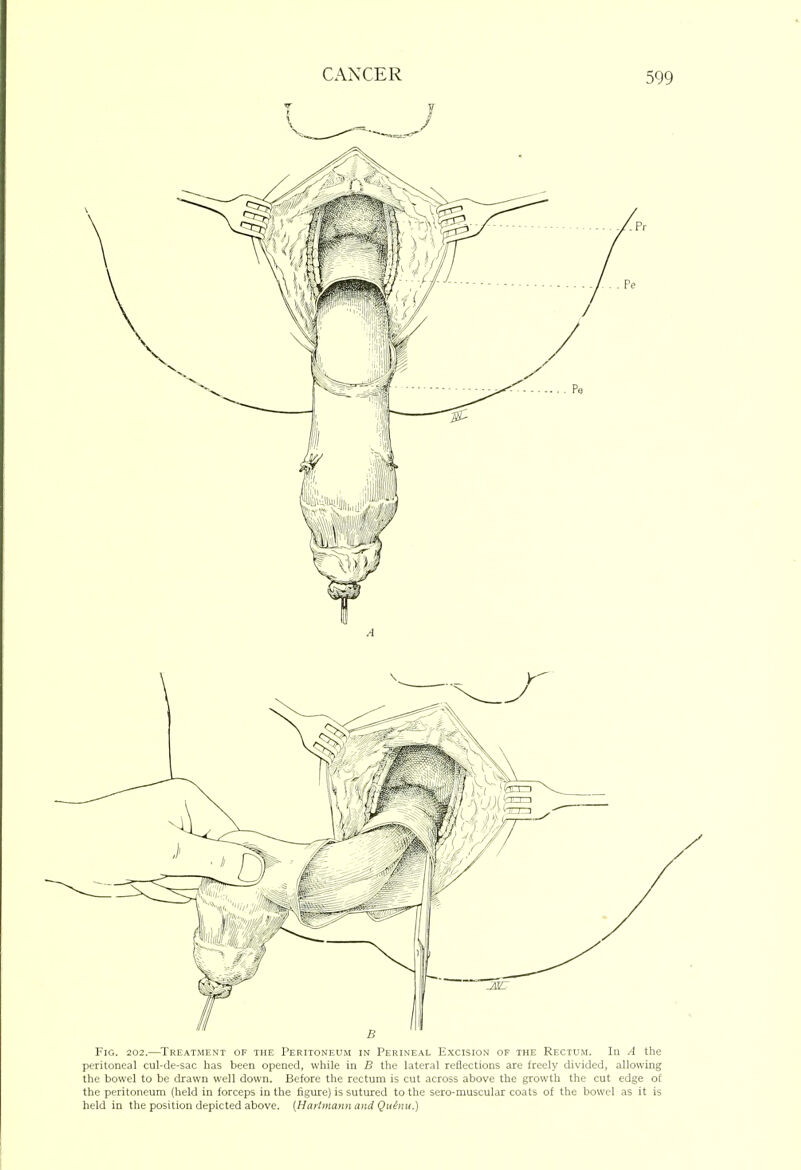 Fig. 202.—Tkeatment of the Peritoneum in Perineal Excision of the Rectum. In A the peritoneal cul-de-sac has been opened, while in B the lateral reflections are freely divided, allowing the bowel to be drawn well down. Before the rectum is cut across above the growth the cut edge of the peritoneum (held in forceps in the figure) is sutured to the sero-muscular coats of the bowel as it is held in the position depicted above. {Hartmann and Qulnu.)
