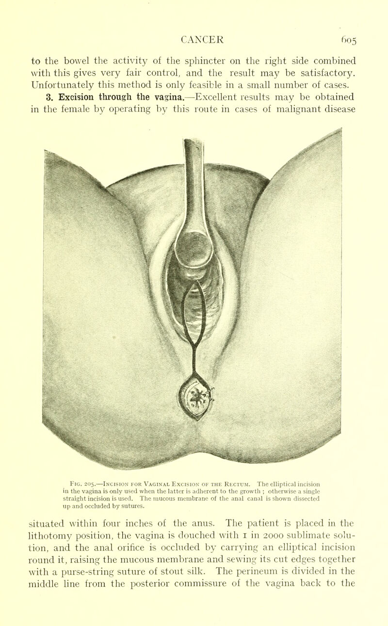 to the bowel the activity of the sphincter on the right side combined with this gives very fair control, and the result may be satisfactory. Unfortunately this method is only feasible in a small number of cases. 3. Excision through the vagina.—Excellent results may be obtained in the female by operating by this route in cases of malignant disease Fig. 205.—Incision for Vaginal Excision of the Rlctum. The elliptical incision in the vagina is only used when the latter is adherent to the growth ; otherwise a single straight incision is used. The mucous membrane of the anal canal is shown dissected up and occluded by sutures. situated within four inches of the anus. The patient is placed in the lithotomy position, the vagina is douched with i in 2000 sublimate solu- tion, and the anal orifice is occhided by carrying an elliptical incision round it, raising the mucous membrane and sewing its cut edges together with a purse-string suture of stout silk. The perineum is divided in the middle line from the posterior commissure of the vagina back to the