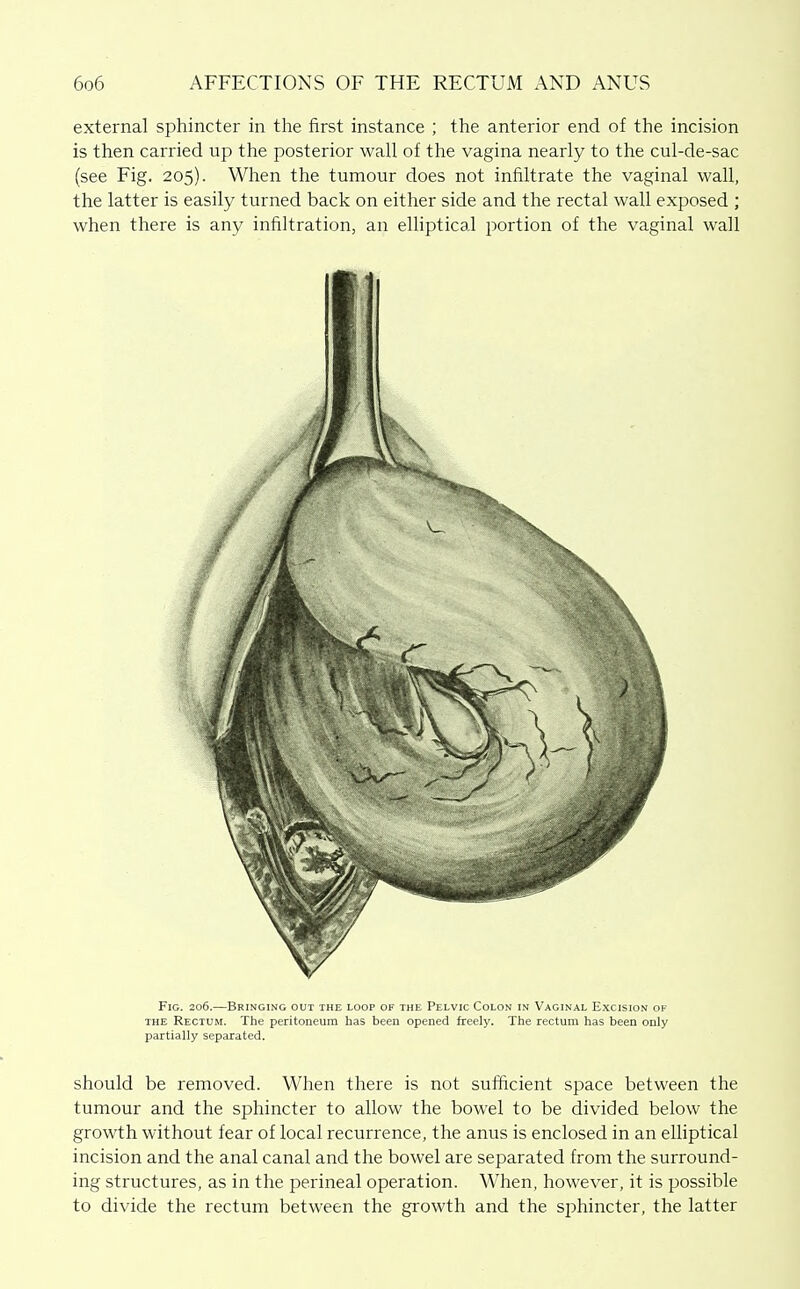 external sphincter in the first instance ; the anterior end of the incision is then carried up the posterior wall of the vagina nearly to the cul-de-sac (see Fig. 205). When the tumour does not infiltrate the vaginal wall, the latter is easily turned back on either side and the rectal wall exposed ; when there is any infiltration, an elliptical portion of the vaginal wall Fig. 206.—Bringing out the loop of the Pelvic Colon in Vaginal Excision of THE Rectum. The peritoneum has been opened freely. The rectum has been only partially separated. should be removed. When there is not sufiicient space between the tumour and the sphincter to allow the bowel to be divided below the growth without fear of local recurrence, the anus is enclosed in an elliptical incision and the anal canal and the bowel are separated from the surround- ing structures, as in the perineal operation. When, however, it is possible to divide the rectum between the growth and the sphincter, the latter