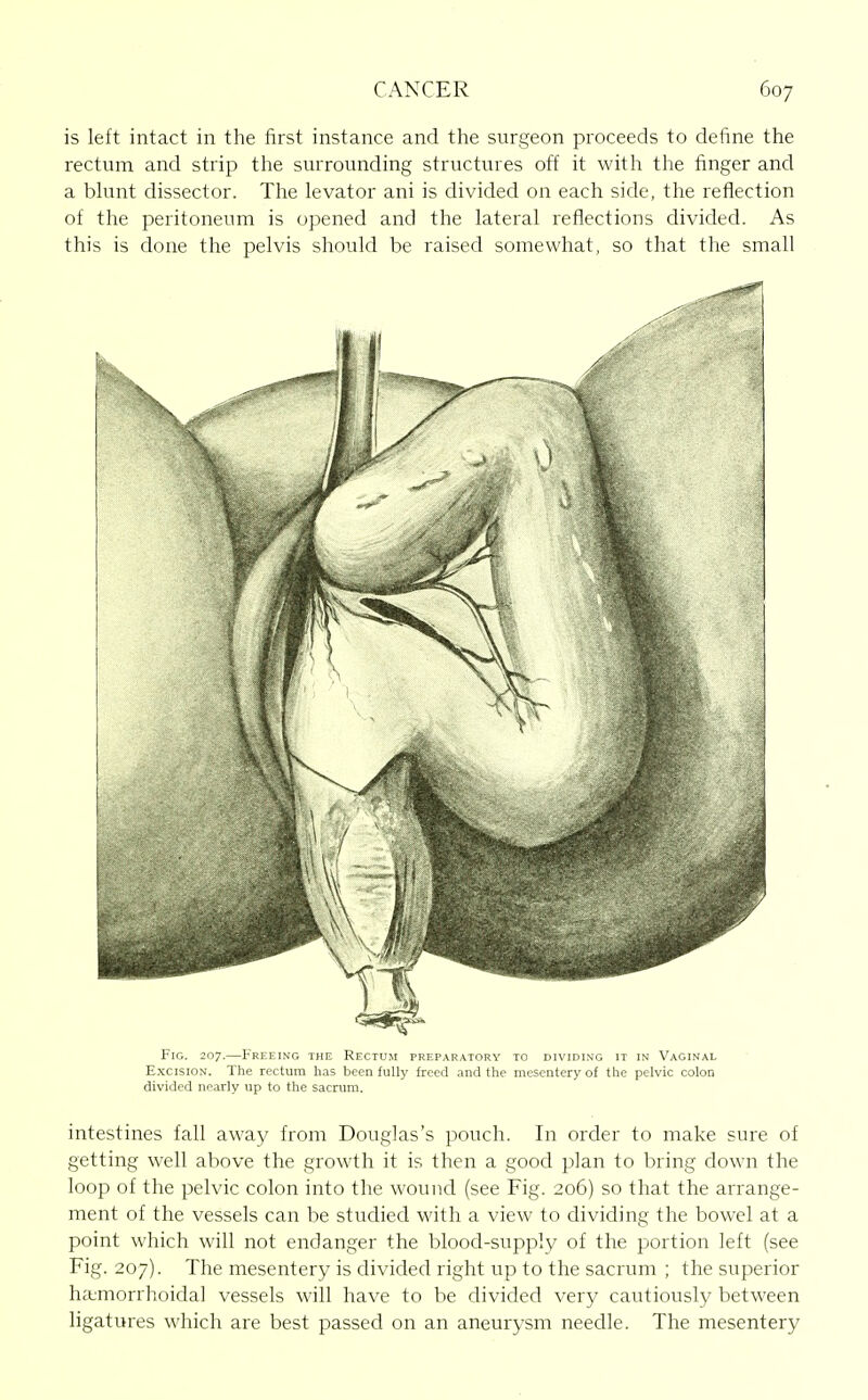 is left intact in the first instance and the surgeon proceeds to define the rectum and strip the surrounding structures off it with the finger and a bkint dissector. The levator ani is divided on each side, the reflection of the peritoneum is opened and the lateral reflections divided. As this is done the pelvis should be raised somewhat, so that the small Fig. 207.—Freeing the Rectum preparatory to dividing it in Vaginal ExcisioN. The rectum has been fully freed and the mesentery of the pelvic colon divided nearly up to the sacrum. intestines fall away from Douglas's pouch. In order to make sure of getting well above the growth it is then a good plan to bring down the loop of the pelvic colon into the wound (see Fig. 206) so that the arrange- ment of the vessels can be studied with a view to dividing the bowel at a point which will not endanger the blood-supply of the portion left (see Fig. 207). The mesentery is divided right up to the sacrum ; the superior hajmorrhoidal vessels will have to be divided very cautiously between ligatures which are best passed on an aneurysm needle. The mesentery