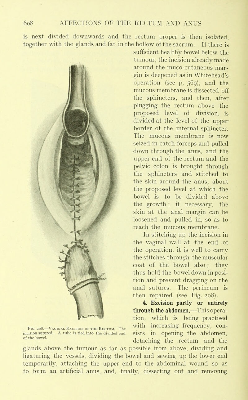 is next divided downwards and the rectum proper is then isolated, together with the glands and fat in the hollow of the sacrum. If there is sufficient healthy bowel below the tumour, the incision already made around the muco-cutaneous mar- gin is deepened as in Whitehead's operation (see p. 569), and the mucous membrane is dissected off the sphincters, and then, after plugging the rectum above the proposed level of division, is divided at the level of the upper border of the internal sphincter. The mucous membrane is now seized in catch-forceps and pulled down through the anus, and the upper end of the rectum and the pelvic colon is brought through the sphincters and stitched to the skin around the anus, about the proposed level at which the bowel is to be divided above the growth; if necessary, the skin at the anal margin can be loosened and pulled in, so as to reach the mucous membrane. In stitching up the incision in the vaginal wall at the end of the operation, it is well to carry the stitches through the muscular coat of the bowel also ; they thus hold the bowel down in posi- tion and prevent dragging on the anal sutures. The perineum is then repaired (see Fig. 208). 4. Excision partly or entirely through the abdomen,—This opera- tion, which is being practised with increasing frequency, con- sists in opening the abdomen, detaching the rectum and the glands above the tumour as far as possible from above, dividing and ligaturing the vessels, dividing the bowel and sewing up the lower end temporarily, attaching the upper end to the abdominal wound so as to form an artificial anus, and, finally, dissecting out and removing Fig. 208.—Vaginal Excision of the Rectum. The incision sutured. A tube is tied into the divided end of the bowel.