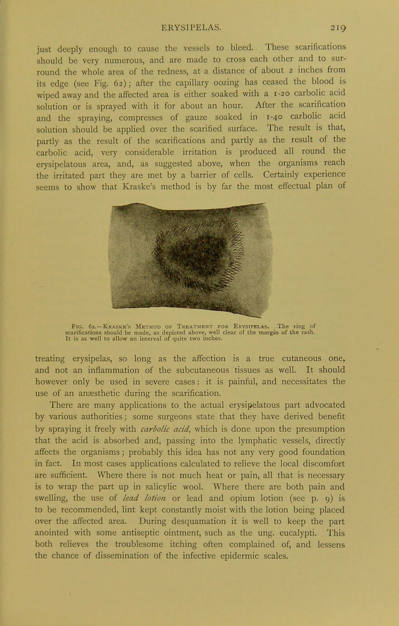 just deeply enough to cause the vessels to bleed. These scarifications should be very numerous, and are made to cross each other and to sur- round the whole area of the redness, at a distance of about 2 inches from its edge (see Fig. 62); after the capillary oozing has ceased the blood is wiped away and the affected area is either soaked with a 1-20 carbolic acid solution or is sprayed with it for about an hour. After the scarification and the spraying, compresses of gauze soaked in 1-40 carbolic acid solution should be applied over the scarified surface. The result is that, partly as the result of the scarifications and partly as the result of the carbolic acid, very considerable irritation is produced all round the erysipelatous area, and, as suggested above, when the organisms reach the irritated part they are met by a barrier of cells. Certainly experience seems to show that Kraske's method is by far the most effectual plan of Fig. 62.—Kraske's Method of Treatment for Erysfpei-as. The ring of scarifications should be made, as depicted above, well clear of the margin of the rash. It is as well to allow an interval of quite two inches. treating erysipelas, so long as the affection is a true cutaneous one, and not an inflammation of the subcutaneous tissues as well. It should however only be used in severe cases: it is painful, and necessitates the use of an anaesthetic during the scarification. There are many applications to the actual erysipelatous part advocated by various authorities; some surgeons state that they have derived benefit by spraying it freely with carbolic acid, which is done upon the presumption that the acid is absorbed and, passing into the lymphatic vessels, directly affects the organisms \ probably this idea has not any very good foundation in fact. In most cases applications calculated to relieve the local discomfort are sufficient. Where there is not much heat or pain, all that is necessary is to wrap the part up in salicylic wool. Where there are both pain and swelling, the use of lead lotion or lead and opium lotion (see p. 9) is to be recommended, lint kept constantly moist with the lotion being placed over the affected area. During desquamation it is well to keep the part anointed with some antiseptic ointment, such as the ung. eucalypti. This both relieves the troublesome itching often complained of, and lessens the chance of dissemination of the infective epidermic scales.