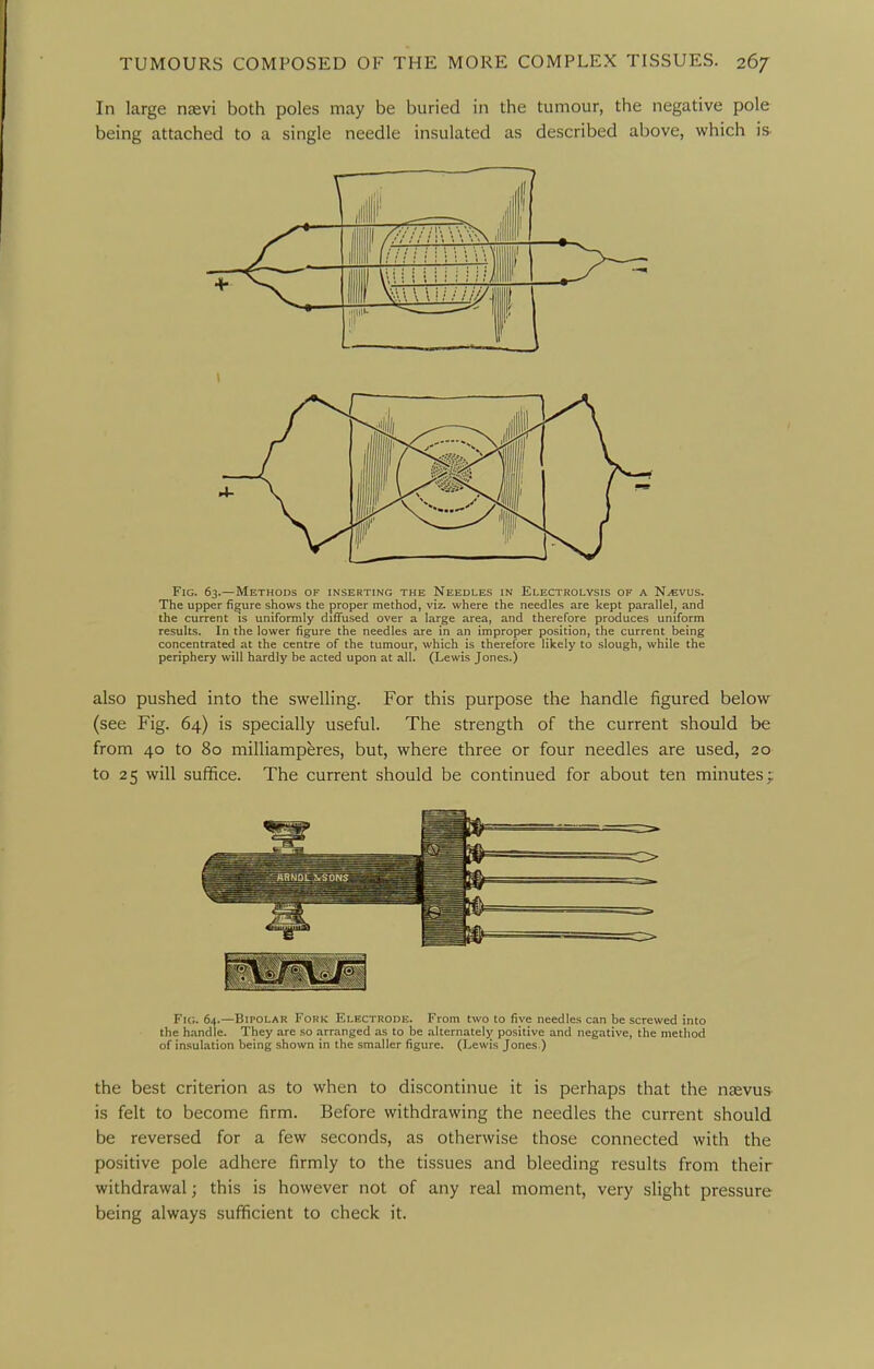 In large ngevi both poles may be buried in the tumour, the negative pole being attached to a single needle insulated as described above, which is. Fig. 63.—Methods of inserting the Needles in Electrolysis of a N-evus. The upper figure shows the proper method, viz. where the needles are kept parallel^ and the current is uniformly diffused over a large area, and therefore produces uniform results. In the lower figure the needles are in an improper position, the current being concentrated at the centre of the tumour, which is therefore likely to slough, while the periphery will hardly be acted upon at all. (Lewis Jones.) also pushed into the swelling. For this purpose the handle figured below (see Fig. 64) is specially useful. The strength of the current should be from 40 to 80 milliamperes, but, where three or four needles are used, 20 to 25 will suffice. The current should be continued for about ten minutes; Fic. 64.—Bipolar Fork Electrode. From two to five needles can be screwed into the h.-indle. They are so .-irranged as to be alternately positive and negative, the method of insulation being shown in the smaller figure. (Lewis Jones ) the best criterion as to when to discontinue it is perhaps that the nsevus- is felt to become firm. Before withdrawing the needles the current should be reversed for a few seconds, as otherwise those connected with the positive pole adhere firmly to the tissues and bleeding results from their withdrawal; this is however not of any real moment, very slight pressure being always sufficient to check it.