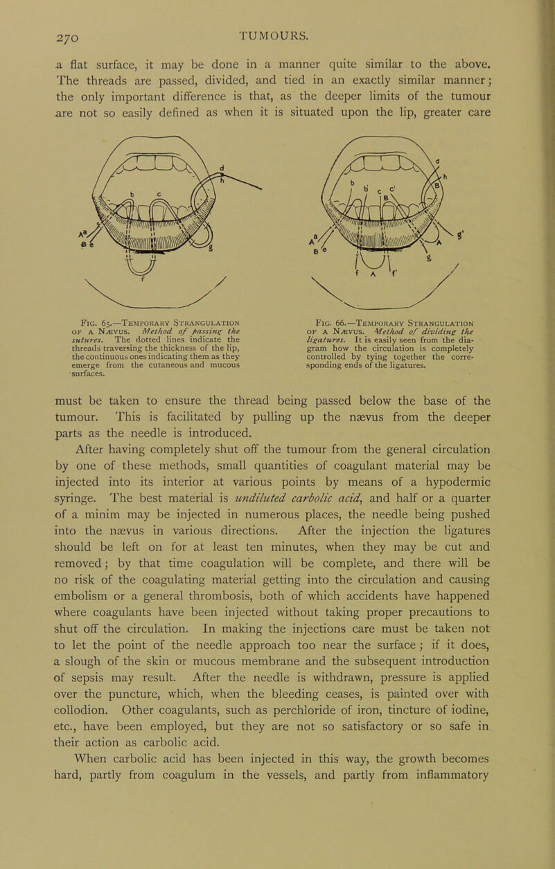 2/0 a flat surface, it may be done in a manner quite similar to the above. The threads are passed, divided, and tied in an exactly similar manner; the only important difference is that, as the deeper limits of the tumour are not so easily defined as when it is situated upon the lip, greater care must be taken to ensure the thread being passed below the base of the tumour. This is facilitated by pulling up the naevus from the deeper parts as the needle is introduced. After having completely shut off the tumour from the general circulation by one of these methods, small quantities of coagulant material may be injected into its interior at various points by means of a hypodermic syringe. The best material is undiluted carbolic acid, and half or a quarter of a minim may be injected in numerous places, the needle being pushed into the nsevus in various directions. After the injection the ligatures should be left on for at least ten minutes, when they may be cut and removed; by that time coagulation will be complete, and there will be no risk of the coagulating material getting into the circulation and causing embolism or a general thrombosis, both of which accidents have happened where coagulants have been injected without taking proper precautions to shut off the circulation. In making the injections care must be taken not to let the point of the needle approach too near the surface; if it does, a slough of the skin or mucous membrane and the subsequent introduction of sepsis may result. After the needle is withdrawn, pressure is applied over the puncture, which, when the bleeding ceases, is painted over with collodion. Other coagulants, such as perchloride of iron, tincture of iodine, etc., have been employed, but they are not so satisfactory or so safe in their action as carbolic acid. When carbolic acid has been injected in this way, the growth becomes hard, partly from coagulum in the vessels, and partly from inflammatory Fig. 65.—Temporary Strangulation OF A NyEVUS. Method of passing the sutures. The dotted lines indicate the threads traversing the thickness of the lip, the continuous ones indicating them as they emerge from the cutaneous and mucous surfaces. Fig. 66.—Temporary Strangulation OF A N.EVUS. Method of dividine the ligatures. It is easily seen from the dia- gram how the circulation is completely controlled by tying together the corre- sponding ends of the ligatures.