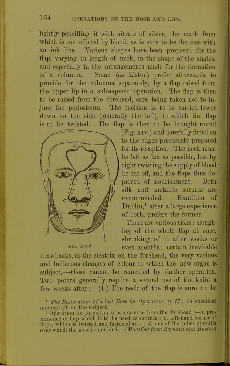 15i lightly pencilling it with nitrate of silver, the mark from which is not effaced by blood, as is sure to be the case with an ink line. Various shapes have been proposed for the flap, varying in length of neck, in the shape of the angles, and especially in the arrangements made for the formation of a columna. Some (as Liston) prefer afterwards to provide for the columna separately, by a flap raised from the upper lip in a subsequent operation. The flap is then to be raised from the forehead, care being taken not to in- jure the periosteum. The incision is to be carried lower down on the side (generally the left), to which the flap is to be twisted. The flap is then to be brought round drawbacks, as the cicatrix on the forehead, the very various and ludicrous changes of colour to which the new organ is subject,—these cannot be remedied by further operation. Two points generally require a second use of the knife a few weeks after:—(1.) The neck of the flap is sure to be ^ The Restoration of a lost Nose by Operation, -p. 57 ; an excellent monograph on the subject. Operation for formation of a new nose from the forehead :—a. pro- minence of flap which is to be used as septum ; h. left-hand corner of flaps, which is twisted and fastened at c. ; cl. one of the tubes or quills over which the nose is vaouXdL&il. —[Modified from Bernard and Huette.) (Fig. XIV.) and carefidly fitted on to the edges previously prepared for its reception. The neck must be left as lax as possible, lest by tight twisting the supply of blood be cut off, and the flaps thus de- prived of nourishment. Both silk and metallic sutures are recommended. Hamilton of Dublin,^ after a large experience of both, prefers the former. KIG. XIV.2 There are various risks: slough- ing of the whole flap at once, shrinking of it after weeks or even months; certain inevitable