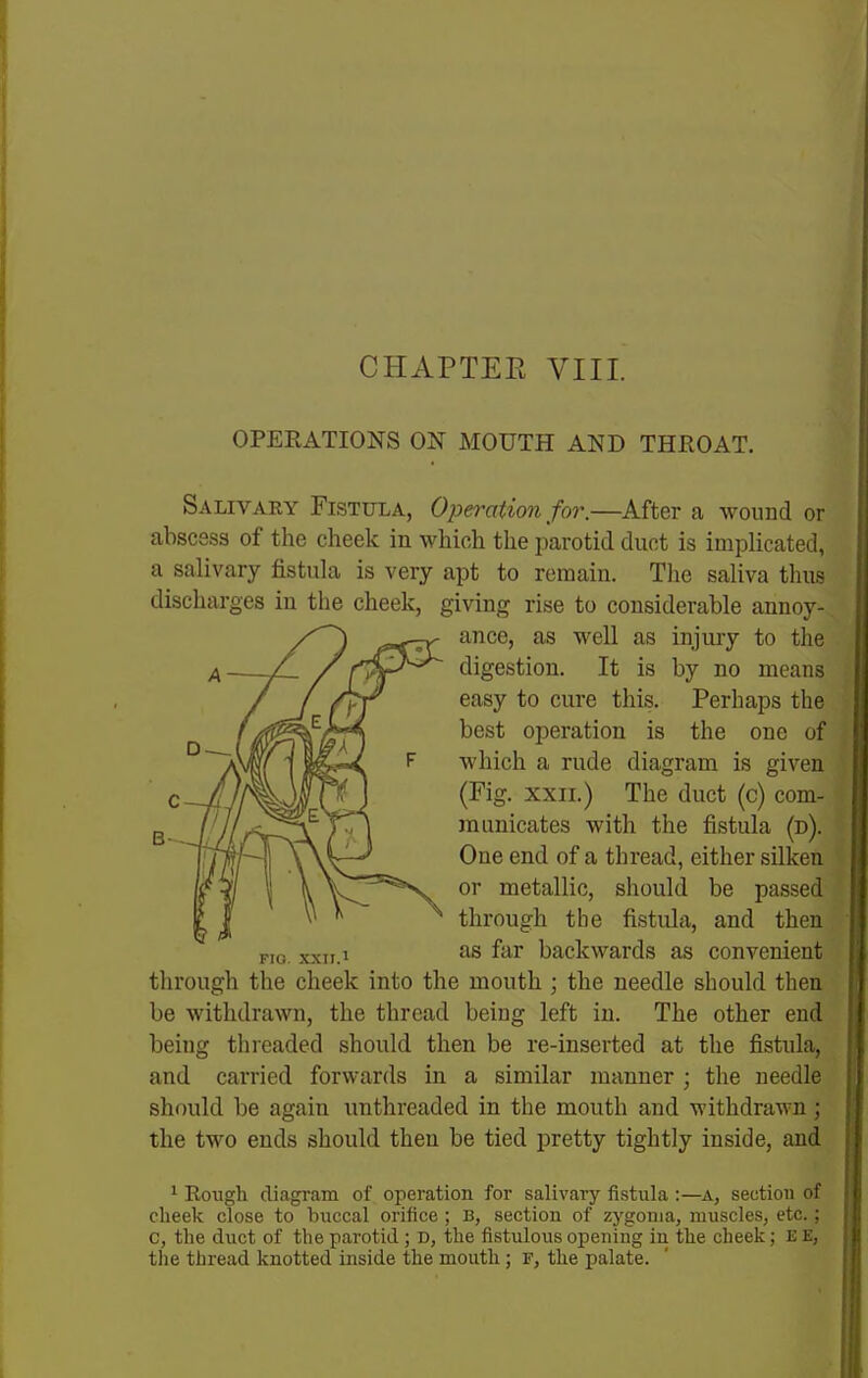 OPERATIONS ON MOUTH AND THROAT. Salivaky Fistula, Operation for.—After a wound or abscess of the cheek in which the parotid duct is implicated, a salivary fistula is very apt to remain. Tlie saliva thus discharges in the cheek, giving rise to considerable annoy- through the cheek into the mouth ; the needle should then be withdrawn, the thread being left in. The other end being tlireaded should then be re-inserted at the fistula, and carried forwards in a similar manner ; the needle should be again unthreaded in the mouth and withdrawn; the two ends should then be tied pretty tightly inside, and ^ Rough diagram of operation for salivary fistula :—A, section of cheek close to buccal orifice ; B, section of zygoma, muscles, etc.; c, the duct of the parotid; D, the fistulous opening in the cheek; E E, tlie thread knotted inside the mouth; F, the palate. B- ance, as well as injury to the digestion. It is by no means easy to cure this. Perhaps the best operation is the one of which a rude diagram is given (Fig. XXII.) The duct (c) com- municates with the fistula (d). One end of a thread, either silken or metallic, should be passed through the fistula, and then as far backwards as convenient Fio. xxn.i