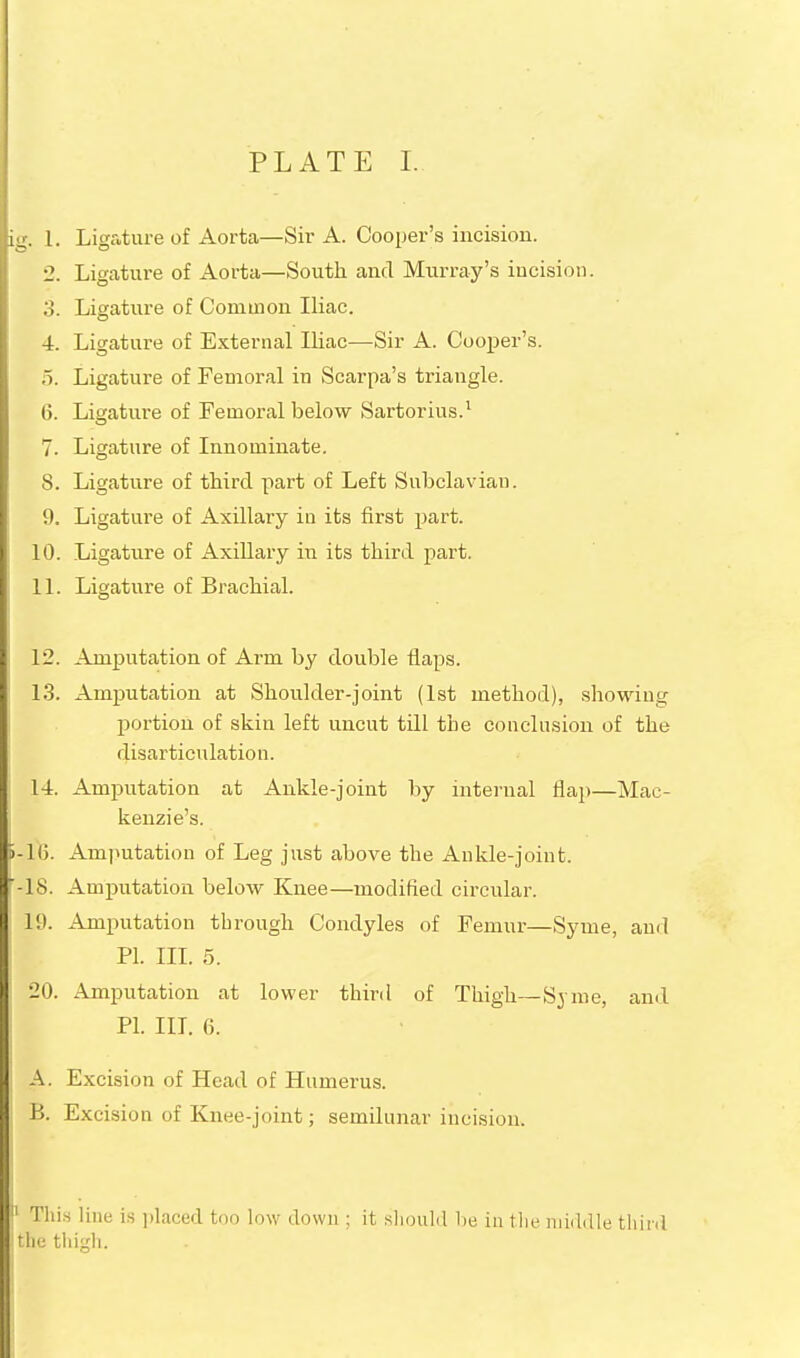 ii. I. Ligature of Aorta—Sir A. Cooper's incision. •J. Ligatui-e of Aorta—South and Murray's incision. ;>. Ligature of Common Iliac. 4. Ligature of External Iliac—Sir A. Cooper's, o. Ligature of Femoral in Scarpa's triangle. 6. Ligature of Femoral below Sartorius.^ 7. Ligature of Innominate. 8. Ligature of tWrd part of Left Subclavian. 9. Ligature of Axillary iu its first part. 10. Ligature of Axillary in its third part. I 11. Ligature of Brachial. 12. Amputation of Arm by double flaps. 13. Amputation at Shoulder-joint (1st method), showing portion of skin left uncut till the conclu,sion of the disarticidation. 14. Amputation at Ankle-joint by internal flap—Mac- kenzie's. 5-lG. Amputation of Leg just above the Ankle-joint. '-18. Amputation below Knee—modified circular. 19. Amputation through Condyles of Femur—Syme, and Ph III. 5. 20. Amputation at lower third of Thigh—Syme, and PL III. 0. A. Excision of Head of Humerus. B. Excision of Knee-joint; semilunar incision. I Tills line i.s placed too low down ; it .should be in tlie middle tliinl I the thigh.