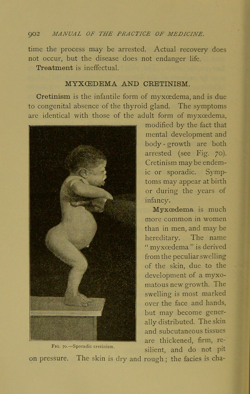 time the process may be arrested. Actual recovery does not occur, but the disease does not endanger life. Treatment is ineffectual. MYX(EDEMA AND CRETINISM. Cretinism is the infantile form of myxcedema, and is due to congenital absence of the thyroid gland. The symptoms are identical with those of the adult form of myxcedema, modified by the fact that mental development and body - growth are both arrested (see Fig. 70). Cretinism maybe endem- ic or sporadic. Symp- toms may appear at birth or during the years of infancy. Myxcedema is much more common in women than in men, and may be hereditary. The name “ myxcedema ” is derived from the peculiar swelling of the skin, due to the development of a myxo- matous new growth. The swelling is most marked over the face and hands, but may become gener- ally distributed. The skin and subcutaneous tissues are thickened, firm, re- Fig. 70.—Sporadic cretinism. ... j j „ *. •«. silient, and do not pit on pressure. The skin is dry and rough ; the facies is cha-