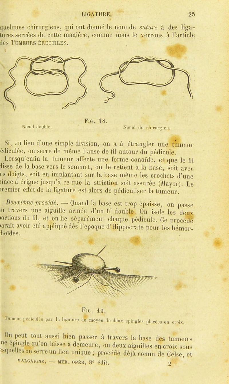 ijuelques chirurgiens, qin ont donné le nom de nature à des liga- tures serrées de cette manière, comme nous le verrons à l'article des Tumeurs érectiles. FiG. 18. Nœud double. Nœud du eliinii'yiuii. Si, au lieu d'une simple division, on a à étrangler une tumeur édiculée, on serre de même l'anse de fil autour du pédicule. Lorsqu'enfm la tumeur affecte une forme conoïde, et que le fil ;lisse de la base vers le sommet, on le retient à la base, soit avec es doigts, soit en implantant sur la base même les crochets d'une )ince à érigne jusqu'à ce que la striction soit assurée (Alayor). Le )remier effet de la hgature est alors de pédiculiser la tumeur. Deuxième frocédé. — Quand la base est trop épaisse, on passe lu travers une aiguille armée d'un fil double. On isole les deux )orlions du fil, et on lie séparément chaque pédicule. Ce procédé tarait avoir été appliqué dès l'époque d'Hippocrate pour les hémor- hoïdes. FiG. 19. Tumeur par la hgatnro an moyen do doux (i-idugles placées eu oroix. On peut tout aussi bien passer à travers la base des tumeurs ne épingle qu'on laisse à demeure, ou deux aiguilles en croix sous îsqnellcson serre un lien unique ; procédé déjà connu de Celse, et MALGAIGNE. — MÉD. OPÉR. S» édit. 9