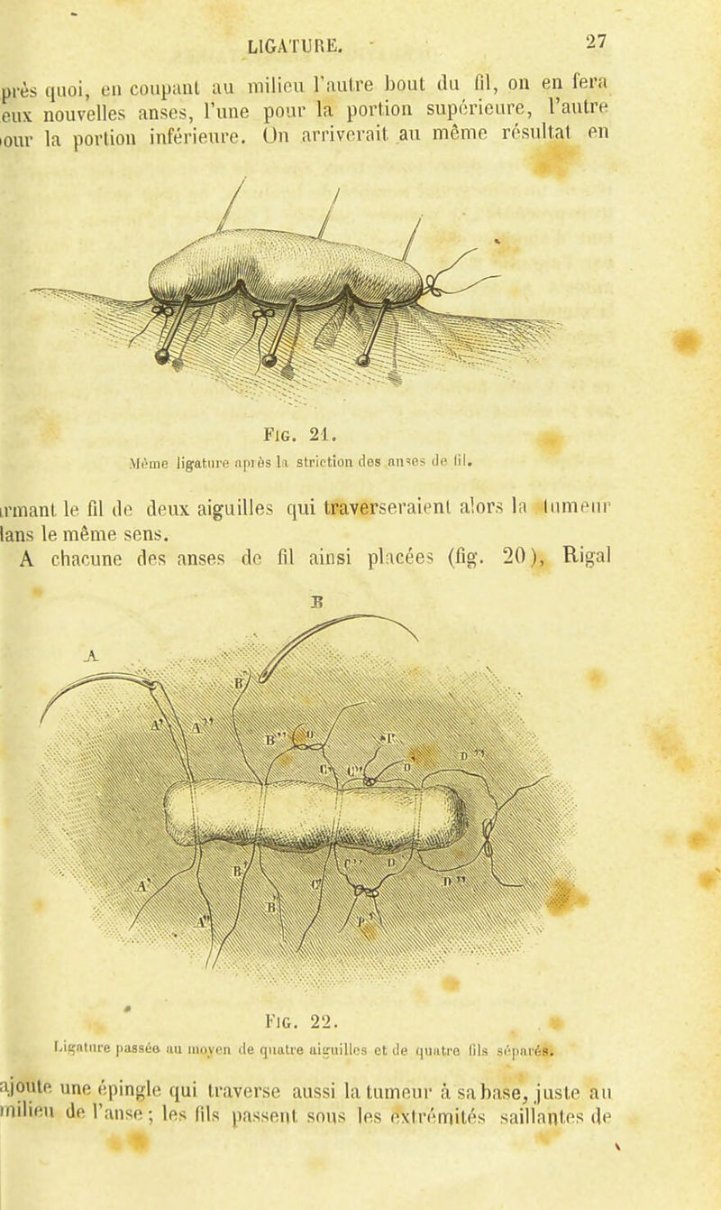 près quoi, en coupanl au milieu l'autre bout du fil, on en fera eux nouvelles anses, l'une pour la portion supérieure, l'autre lour la porliou inférieure. Un arriverait au nriême résultat en FiG. 21. Mi'me ligature apiôs la striction dos nn^os df> lil. irmant le fil de deux aiguilles qui traverseraient alors In lumeur lans le même sens. A chacune des anses de fil ainsi placées (fig. 20), Rigal l'iG. 22. I.igntiire passé» im moyen (le quatre aiguilles et Je quatre fils S(''p(ii'é8. ajoute une épingle qui traverse aussi la tumeur à sa base, juste au milieu de l'anse ; les fils passent sous les extrémités saillantes de