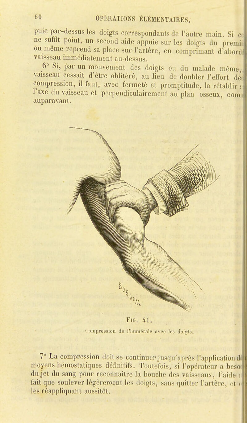 puie par-dessus les doigts correspondants de l'autre main. Si < ne suffit point, un second aide appuie sur les doigts du prem ou même reprend sa place sur l'artère, en comprimant d'aborc vaisseau mimédialement au-dessus. 6 Si, par un mouvement des doigts ou du malade même, vaisseau cessait d'être oblitéré, au lieu de doubler l'effort det compression, il faut, avec fermeté et promptitude, la rétablir i l'axe du vaisseau et perpendiculairement au plan osseux, comii auparavant. FiG. M. Coinpressioa do l'iiumérale avec les doigls. 7 La compression doit se continuer jusqu'après l'application dd moyens hémostatiques définitifs. Toutefois, si l'opérateur a beso( du jet du sang pour reconnaître la bouche des vaisseaux, l'aide i fait que soulever légèrenaent les doigts, sans quider l'artère, et i les réappliquant aussitôt.