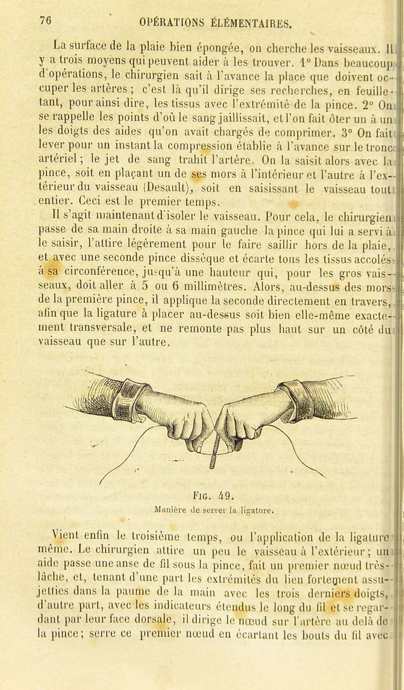 s. La surface de la plaie bien épongée, on cherche les vaisseaux. Il y a trois moyens qui peuvent aider à les trouver. 1° Dans beaucouji d'opérations, le chirurgien sait à l'avance la place que doivent oc • , cuper les artères ; c'est là qu'il dirige ses recherches, en feuille- tant, pour ainsi dire, les tissus avec l'extrémité de la pince. 2° Oni se rappelle les points d'où le sang jaillissait, et l'on fait ôter un à uni les doigts des aides qu'on avait chargés de comprimer, 3° On faitl lever pour un instant la compression établie à l'avance sur le troncc artériel; le jet de sang trahit l'artère. On la saisit alors avec lai pince, soit en plaçant un de ses mors cà l'intérieur et l'autre à l'ex- térieur du vaisseau (Desault), soit en saisissant le vaisseau toutl entier. Ceci est le premier temps. Il s'agit niaintenantd'isoler le vaisseau. Pour cela, le chirurgieni passe de sa main droite à sa main gauche la pince qui lui a servi ài le saisir, l'attire légèrement pour le faire saillir hors de la plaie,, et avec une seconde pince dissèque et écarle tous les tissus accolés^ à sa circonférence, jusqu'à une hauteur qui, pour les gros vais- seaux, doit aller à 5 ou 6 millimètres. Alors, au-dessus des mors« de la première pince, il applique la seconde directement en travers,, afin que la ligature à placer au-dessus soit bien elle-même exacte- ment transversale, et ne remonte pas plus haut sur un côté dui vaisseau que sur l'autre. FiG. 49. Manière de sefier la ligoture. Vient enfin le troisième temps, ou l'application de la ligature' même. Le chirurgien attire un peu le vaisseau à l'extérieur; uni aide passe une anse de fil sous la pince, fait un premier nœud très-- lâche, et, tenant d'une part les extrémités du lien forleQient assu-- jetlies dans la paume delà main avec les trois derniers doigts,, d'autre part, avec les indicateurs étendus le long du fil et se regar- dant par leur face dorsale, il dirige le nœud sur l'artère au delà de - là pince; serre ce premier nœud en écartant les bouts du fil avec: