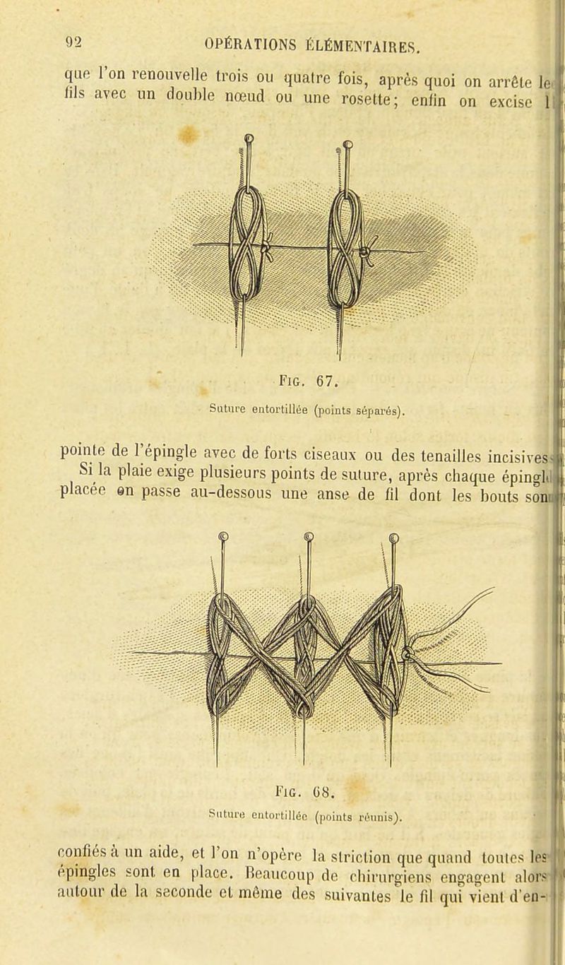 que l'on renouvelle trois ou quatre fois, après quoi on arrête le i fils avec un double nœud ou une rosette; enfin on excise ï FiG. 67. Sutm-e entortillée (points séparés). pointe de Tépingle avec de forts ciseaux ou des tenailles incisives! Si la plaie exige plusieurs points de suture, après chaque épingitl placée en passe au-dessous une anse de fil dont les bouts som FiG. 08. Suture entortillée (points réunis). confiés à un aide, et l'on n'opère la striction que quand toulcs hi épingles sont en place. Beaucoup de chirurgiens engagent alorf. autour de la seconde et môme des suivantes'le fil qui vient d'en-i