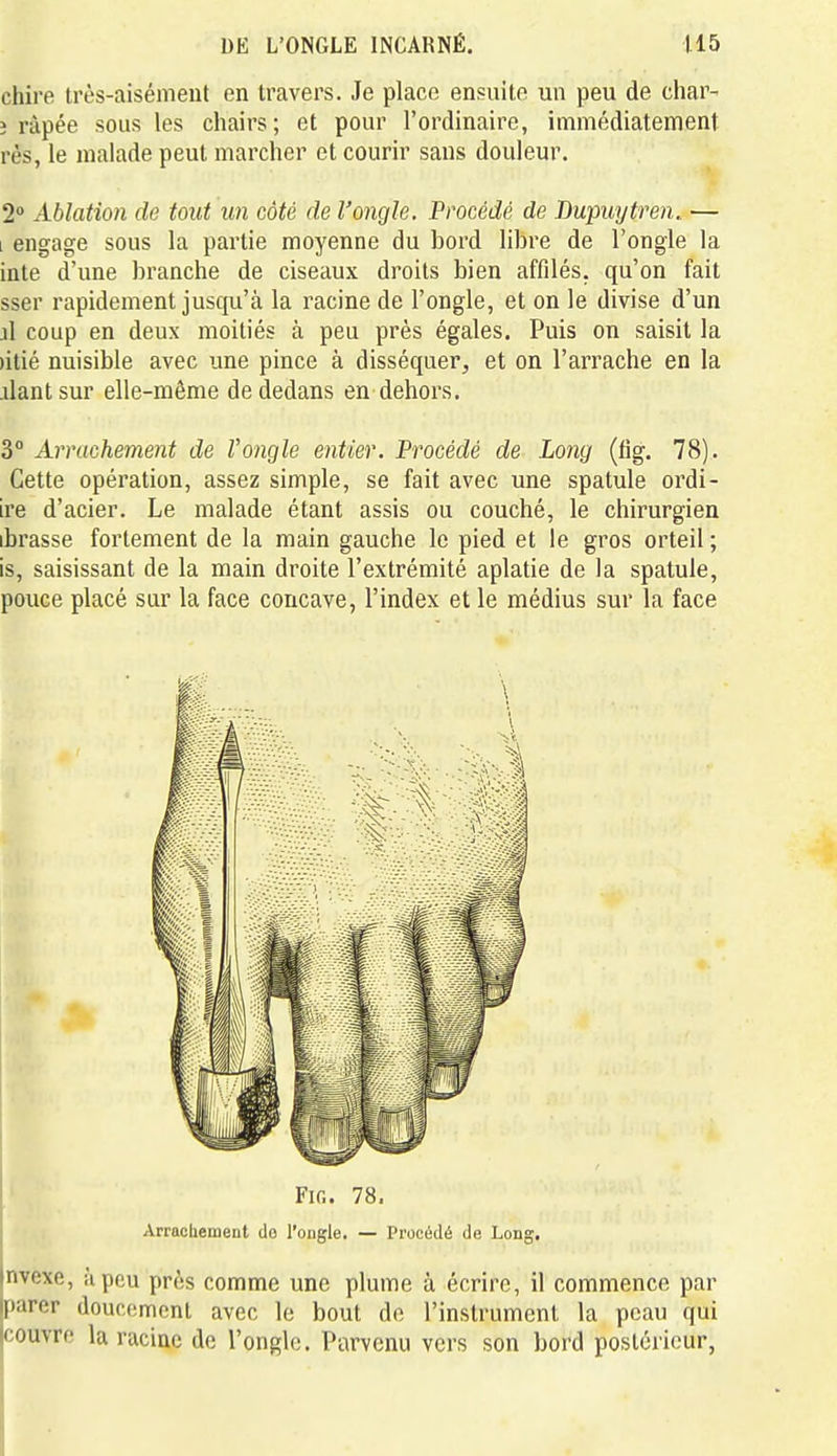 chire très-aisément en travers. Je place ensuite un peu de char- î râpée sous les chairs; et pour l'ordinaire, immédiatement rès, le malade peut marcher et courir sans douleur. 2» Ablation de tout un côté de l'ongle. Procédé de Dupuytren,. — I engage sous la partie moyenne du bord libre de l'ongle la inte d'une branche de ciseaux droits bien affilés, qu'on fait sser rapidement jusqu'à la racine de l'ongle, et on le divise d'un i\ coup en deux moitiés à peu près égales. Puis on saisit la )itié nuisible avec une pince à disséquer, et on l'arrache en la .dantsur elle-même de dedans en dehors. 3° Arrachement de l'ongle entier. Procédé de Long (fig. 78). Cette opération, assez simple, se fait avec une spatule ordi- ire d'acier. Le malade étant assis ou couché, le chirurgien ibrasse fortement de la main gauche le pied et le gros orteil ; is, saisissant de la main droite l'extrémité aplatie de la spatule, pouce placé sur la face concave, l'index et le médius sur la face Fig. 78. Arrachement do l'ongle. — Procédé de Long. nvexe, à peu près comme une plume à écrire, il commence par parer doucement avec le bout de l'instrument la peau qui couvre la racine de l'ongle. Parvenu vers son bord postérieur,