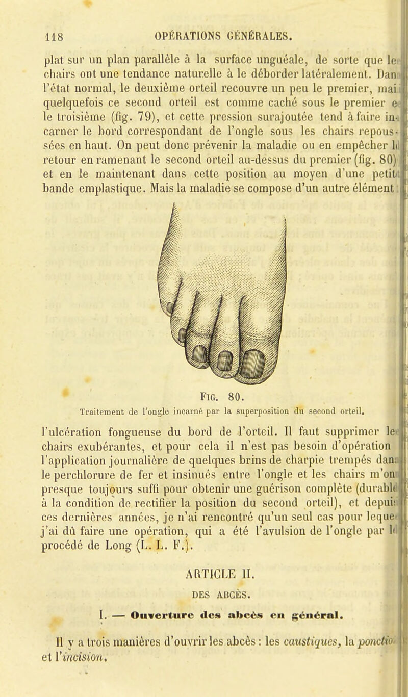 plat sur un plan parallèle à la surface unguéale, de sorte que le chairs ont une tendance naturelle à le déborder latéralement. Dan l'état normal, le deuxième orteil recouvre un peu le premier, mai quelquefois ce second orteil est comme caché sous le premier e le troisième (fig. 79), et cette pression surajoutée tend à faire in- carner le bord correspondant de l'ongle sous les chairs repous sées en haut. On peut donc prévenir la maladie ou en empêcher h retour en ramenant le second orteil au-dessus du premier (fig. 80j > et en le maintenant dans cette position au moyen d'une petitit bande emplastique. Mais la maladie se compose d'un autre élément i II Fig. 80. Traitement de l'ongle incarné par la superposition du second orteil. l'ulcération fongueuse du bord de l'orteil. Il faut supprimer le< chairs exubérantes, et pour cela il n'est pas besoin d'opération l'application journalière de quelques brins de charpie trempés daai le perchlorure de fer et insinués entre l'ongle et les chairs m'o; presque toujours suffi pour obtenir une guérison complète (durabl à la condition de rectifier la position du second orteil), et depuiii ces dernières années, je n'ai rencontré qu'un seul cas pour lequ j'ai dû faire une opération, qui a été l'avulsion de l'ongle par procédé de Long (L. L. F.). ARTICLE II. DES ABCÈS. I. — Ouverture des abcès en général. Il y a trois manières d'ouvrir les abcès : les caustiques, la pondio et l'incision.