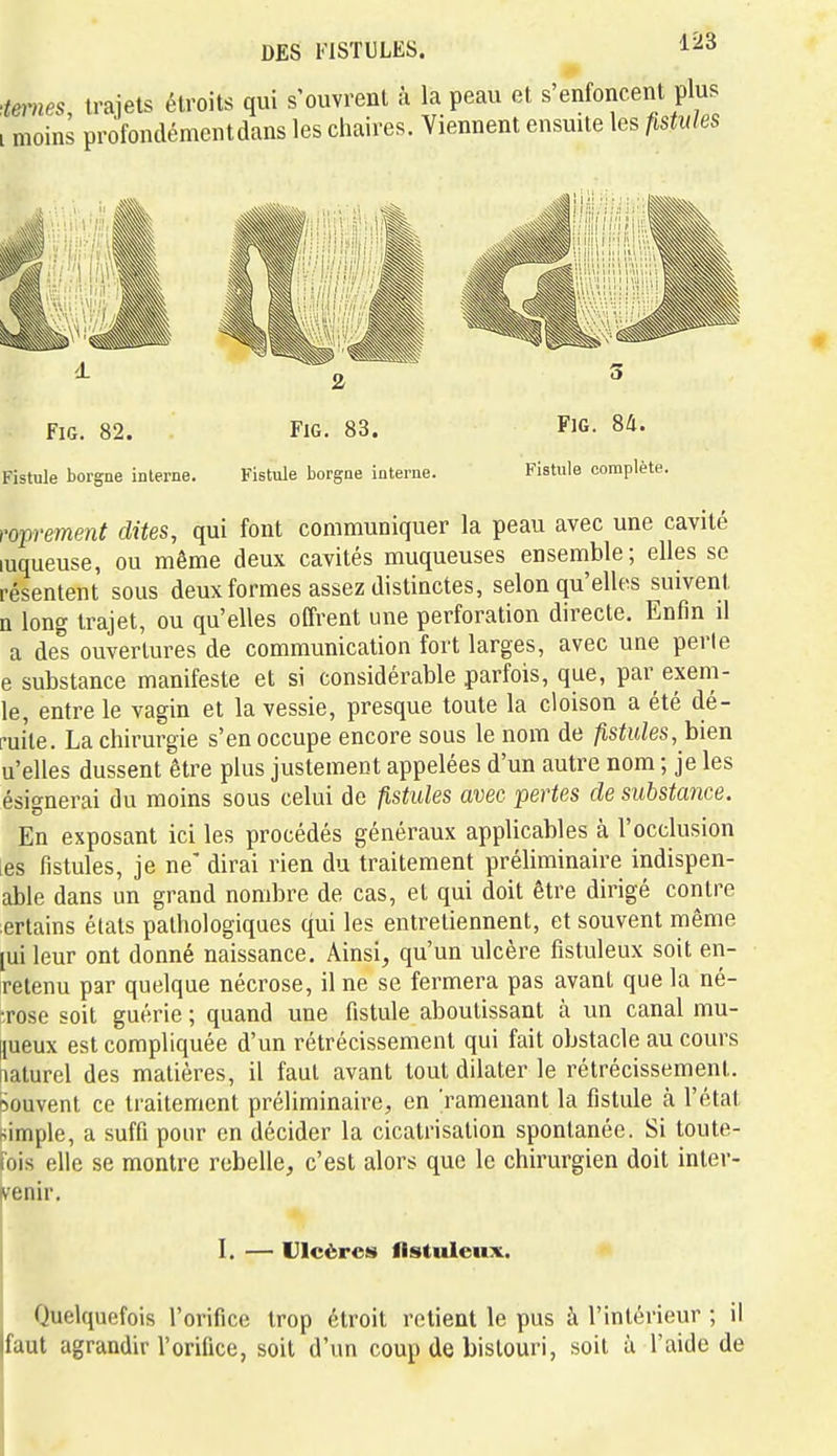 '.ternes, trajets étroits qui s'ouvrent à la peau et s'enfoncent plus i moins profondémentdans les chaires. Viennent ensuite les fistules FiG. 82. FiG. 83. FiG- 84. Fistule borgne interne. Fistule borgne interne. Fistule complète. t'oprement dites, qui font communiquer la peau avec une cavité luqueuse, ou même deux cavités muqueuses ensemble; elles se résentent sous deux formes assez distinctes, selon qu'elles suivent n long trajet, ou qu'elles offrent une perforation directe. Enfin il a des ouvertures de communication fort larges, avec une perle e substance manifeste et si considérable parfois, que, par exem- le, entre le vagin et la vessie, presque toute la cloison a été dé- fuite. La chirurgie s'en occupe encore sous le nom de fistules, bien u'elles dussent être plus justement appelées d'un autre nom ; je les ésignerai du moins sous celui de fistules avec pertes de substance. En exposant ici les procédés généraux applicables à l'occlusion [es fistules, je ne dirai rien du traitement préliminaire indispen- able dans un grand nombre de cas, et qui doit être dirigé contre :ertains états pathologiques qui les entretiennent, et souvent même [ui leur ont donné naissance. Ainsi, qu'un ulcère fistuleux soit en- relenu par quelque nécrose, il ne se fermera pas avant que la né- •rose soit guérie ; quand une fistule aboutissant à un canal mu- |{ueux est compliquée d'un rétrécissement qui fait obstacle au cours naturel des matières, il faut avant tout dilater le rétrécissement, rsouvent ce traitement préliminaire, en 'ramenant la fistule à l'état «impie, a suffi pour en décider la cicatrisation spontanée. Si toute- fois elle se montre rebelle, c'est alors que le chirurgien doit inter- ivenir. I. — Ulcères fistuleux. Quelquefois l'orifice trop étroit retient le pus à l'intérieur ; il laiil agrandir l'orifice, soit d'un coup de bistouri, soit ii l'aide de