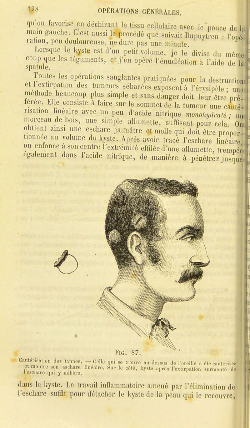 qu'on favorise en décl.ii-ant le lissu cellulaire avec le pouce de !• main gauche C'est aussi le procédé que suivait Dupuytre.i • l'on/, ration, peu douloureuse, ne dure pas une minute Lorsque le kyste est d'un petit volume, je le' divise du même coup que les téguments, et j'en opère l'énucléation à l'aide de la spatule. Toutes les opérations sanglantes pratiiuées pour la destruction et 1 extirpation des tumeurs sébacées exposent à l'érysipèle • un- méthode beaucoup plus simple et sans danger doit leur être pré- leree. Elle consiste à faire sur le sommet de la tumeur une cauté- risation hneaire avec un peu d'acide nitrique monohydralé ■ un morceau de bois, une simple allumette, suffisent pour cela' On obtient amsi une eschare jamiâtre et molle qui doit être propor- tionnée au volume du kyste. Après avoir tracé l'eschare linéaire on enfonce a son centre l'extrémité effilée d'une allumette, trempées également dans l'acide nitrique, de manière à pénétrer jusqu^< FiG. 87 Cnnténsation (I03 tannes. - Colla qui se tmnve au-dessus de l'oreille n été cnulrns.v et montre son eso mre linéaire. Sur le cùlé, kyste après l'extirpation surmonté .U- l eseliaro qni y adhère. dans le kyste. Le travail indammaloiro amené par l'élimination de l'eschare suffit pour détacher le kyste de la peau qui le recouvre,