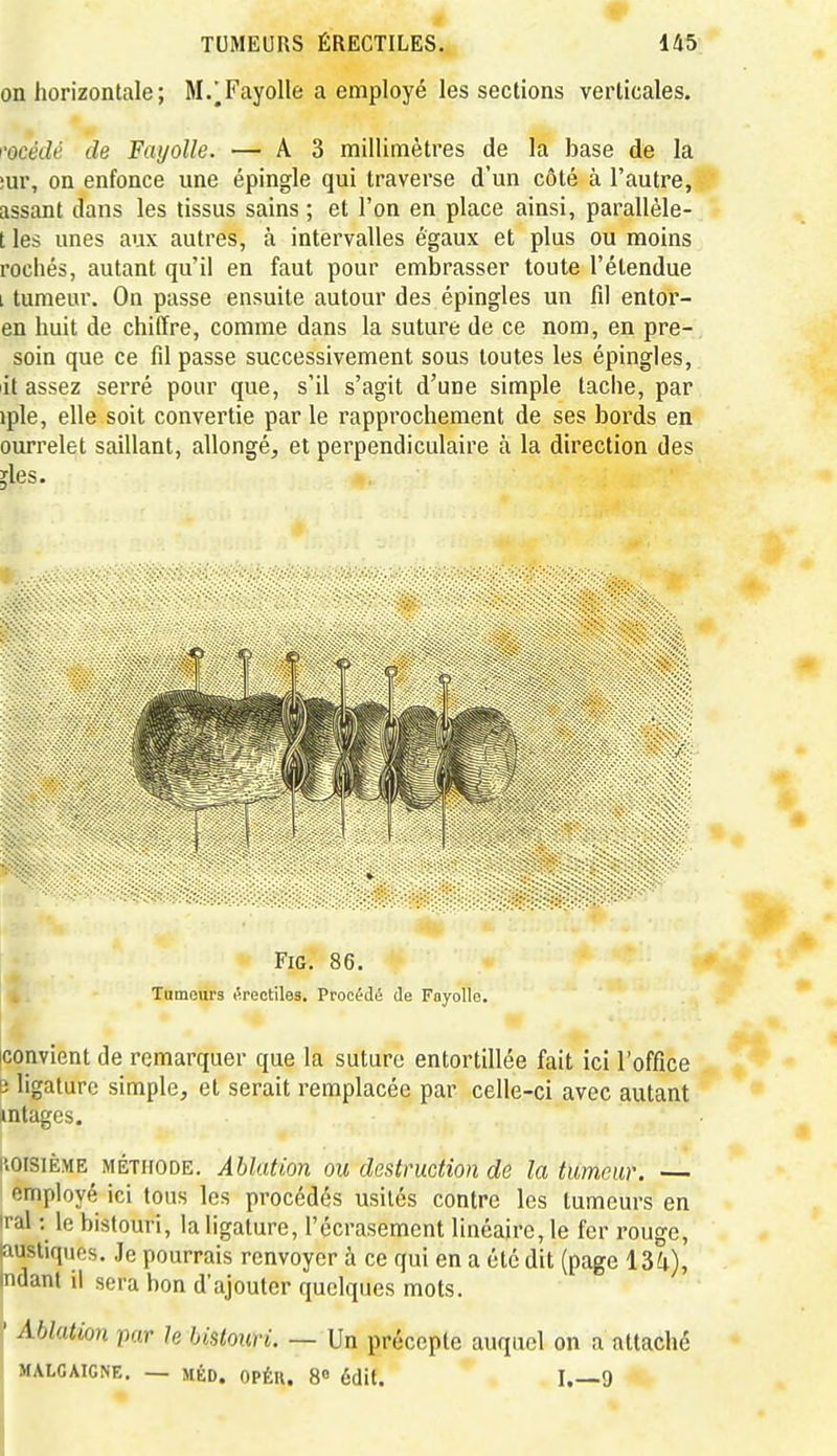 ■t on horizontale; M/Fayolle a employé les sections verticales. l'océde de Fayolle. — A3 millimètres de la base de la ;m% on enfonce une épingle qui traverse d'un côté à l'autre, ^ assant dans les tissus sains ; et l'on en place ainsi, parallèle- t les unes aux autres, à intervalles égaux et plus ou moins rocliés, autant qu'il en faut pour embrasser toute l'étendue i tumeur. On passe ensuite autour des épingles un fil entor- en huit de chiffre, comme dans la suture de ce nom, en pre- soin que ce fil passe successivement sous toutes les épingles, lit assez serré pour que, s'il s'agit d'une simple tache, par iple, elle soit convertie par le rapprochement de ses bords en ourrelet saillant, allongé, et perpendiculaire à la direction des jles. FiG. 86. Tumeurs éreotiles. Procédé de Foyollo. [convient de remarquer que la suture entortillée fait ici l'office B ligature simple, et serait remplacée par celle-ci avec autant mtages. l'.oisiÈME MÉTHODE. Ablation ou destruction de la tUmeur. — employé ici tous les procédés usités contre les tumeurs en irai : le bistouri, la ligature, l'écrasement linéaire, le fer rouge, jausliqucs. Je pourrais renvoyer à ce qui en a été dit (page 13^), indant il sera bon d'ajouter quelques mots. ' Ablation par h bistouri. — Un précepte auquel on a attaché MALGAIGNE. — mÉD. OPÉR. 8 édit. I.—9