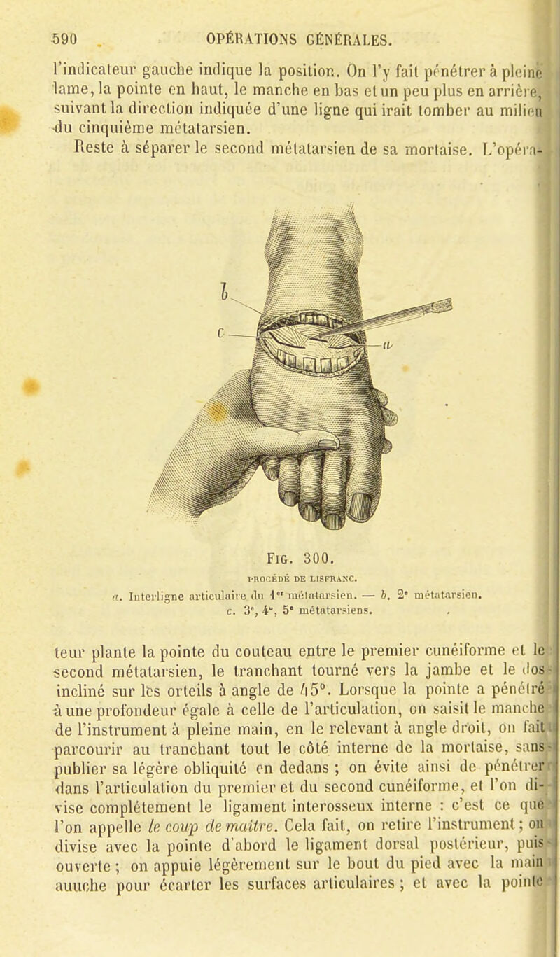 l'indicaleur gauche indique la position. On l'y fait pénétrer à pleine lame, la pointe on haut, le manche en bas et un peu plus en arrière, suivant la direction indiquée d'une ligne qui irait tomber au milieu ■du cinquième métatarsien. Reste à séparer le second métatarsien de sa mortaise, L'opéra- FiG. 300. l'ROCÉDÉ DE LISFRANC. a. Interligne articulaire An 1 uiélatnrsien. — b. 2« métatarsien, c. 3', 4, 5* métatarsiens. leur plante la pointe du couteau entre le premier cunéiforme et le second métatarsien, le tranchant tourné vers la jambe et le dos incliné sur les orteils à angle de Zi5°. Lorsque la pointe a pénciré à une profondeur égale à celle de l'articulaiion, on saisit le manche de l'instrument à pleine main, en le relevant à angle droit, on fait parcourir au tranchant tout le côté interne de la mortaise, sans publier sa légère obliquité en dedans ; on évite ainsi de pcnélrer dans l'articulation du premier et du second cunéiforme, et l'on di- vise complètement le ligament interosseux interne : c'est ce que l'on appelle le coup de maître. Cela fait, on retire l'instrument ; ou divise avec la pointe d'abord le ligament dorsal postérieur, puis ouverte ; on appuie légèrement sur le bout du pied avec la maiu auuche pour écarter les surfaces articulaires ; et avec la pointe