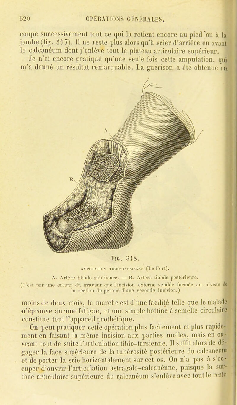 coupe successivcmeni tout ce qui la relient encore au pied ou à iP jiimbe (fig. 31 7). 11 ne reste plus alors qu'à scier d'arrière en avont le calcanéum dont j'enlève tout le plateau articulaire supérieur. Je n'ai encore pratiqué qu'une seule fois cette amputation, qui m'a donné un résultat remarquable. La guérison a été obtenue ( a FiG. 318. AMPUTATIO.N TIDIO-TAUSIENNE (Lo Fort). A. Ai'tùrn tibialo nnlérienre. — B. Artère tibiiile postérieure. (c'est par une erreur du graveur qno l'incision externe semble formée au niveau tle la section du péroné d'une seconde incision.) moins de deux mois, la marclie est d'une facilité telle que le malade «'éprouve aucune fatigue, et une simple bottine à semelle circulaire constitue tout l'appareil prolhétique. On peut pratiquer cette opération plus facilement et plus rapide- nient en faisant la même incision aux parties molles, mais en ou- vrant tout de suite l'articulation tiliio-larsienne. 11 suffit alors de dé- gager la face supérieure de la tubérosité postérieure du calcanéum et déporter la scie horizontalement sur cet os. On n'a pas à s'oc- cuper d'ouvrir l'articiilalion aslragalo-calcanénnc, puisque la sur- face articulaire supérieure du calcanéum s'enlève avec tout le reste