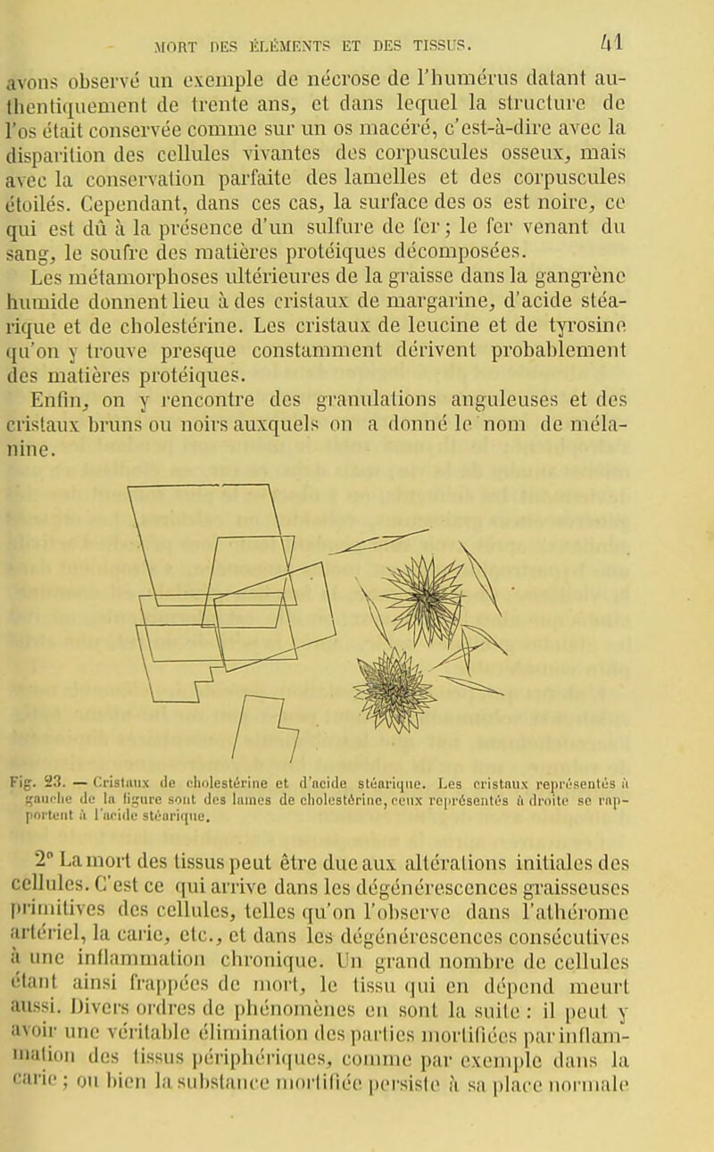 MORT DES ÉLÉMENTS ET DES TISSUS. kl avons observé un exemple de nécrose de l'humérus datant au- llientiquement de trente ans, et dans lequel la structure de l'os était conservée comme sur un os macéré, c'est-à-dire avec la disparition des cellules vivantes des corpuscules osseux, mais avec la conservation parfaite des lamelles et des corpuscules étoilés. Cependant, dans ces cas, la surface des os est noire, ce qui est dû à la présence d'un sulfure de fer ; le fer venant du sang, le soufre des matières protéiques décomposées. Les métamorphoses ultérieures de la gi'aisse dans la gangrène humide donnent lieu à des cristaux de margarine, d'acide stéa- rique et de cholestérine. Les cristaux de leucine et de tyrosine qu'on y trouve presque constamment dérivent probablement des matières protéiques. Enfin, on y i-encontre des granulations anguleuses et des cristaux bruns ou noirs auxquels on a donné le nom de méla- nine. Fig. 23. — Cristniix de cholestérine et d'acide stéai'iiiiie. Les cristnux l'epK'sentés » gminlie de In ligure sont des lames de cholcstiirine, ceux représentés l'i droite so rap- portent il l'acide stéariqiie. 2 Lamoi-t des tissus peut être duc aux altérations initiales des ccUules. C'est ce qui arrive dans les dégénérescences graisseuses primitives des cellules, telles f(u'on rol)serve dans l'alhérome artériel, la carie, etc., et dans les dégénéi'escences consécutives à une inflammation chronique. Un grand nombre de cellules étant ainsi frappées de morl, le tissu (jui en dépend meurt aussi. Divers ordres de phénomènes en sont la suite : il peut y avoir une véritable éliniinalion des parlies morliilées parinflam- lualion des tissus périphéi'i(|ues, comme par exemple dans la carie ; ou bien la substance niorlifiée persiste h sa place normale