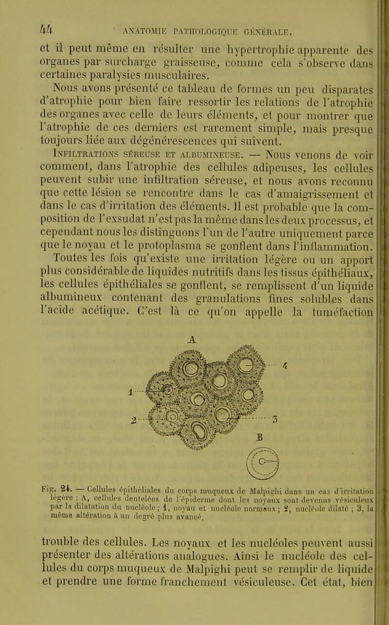 et il peut même en résuller une hypertrophie apparente de- organes par surcharge graisseuse, comme cela s'ohserve dan- certaines paralysies musculaires. Nous avons présenté ce taljleau de formes un peu disparate- d'atrophie pour hien faire ressortir les relations de l'atropliie des organes avec celle de leurs éléments, et pour montrer que l'atrophie de ces derniers est rarement simple, mais presqn toujours liée au.x; dégénérescences qui suivent. Infiltrations séreuse et albumineuse. — Nous venons de -soir comment, dans l'atrophie des cellules adipeuses, les cellule- peuvent suhir une infiltration séreuse, et nous avons reconnu que cette lésion se rencontre dans le cas d'amaigi-issement el dans le cas d'irritation des éléments. 11 est probable que la com- position de l'exsudat n'est pas la même dans les deux processus, el cependant nous les distinguons l'un de l'autre uniquement parce que le noyau et le protoplasma se gonflent dans l'inflammation. Toutes les fois qu'existe une irritation légère ou un appoi I plus considérable de liquides nutritifs dans les tissus épithéliau\. les cellules épithéliales se gonflent, se remplissent d'un liquid albumineux contenant des granulations fines solubles daii^- l'acide acétique. C'est là ce qu'on appelle la tuméfaclion A Fig. 24. — Cellules épitliéliules du corps muqueux de Mnlpiglii dans nn cns d'irritai légère : A, cellules dentelées de l'épiderine dont les niivaux sont devenus vésicul, i par In ddatatiou du nucléole ; 1, noyau et nucléole normsux ; », nucléole dilaté ; o. même altération i un degré plus avancé. trouble des cellules. Les noyaux et les nucléoles peuvent aus>i présenter des altérations analogues. Ainsi le nucléole des cel- lules du corps muqueux de Malpighi peut se remplir de liquide et prendre une forme franchement vésiculeuse. Cet état, bien