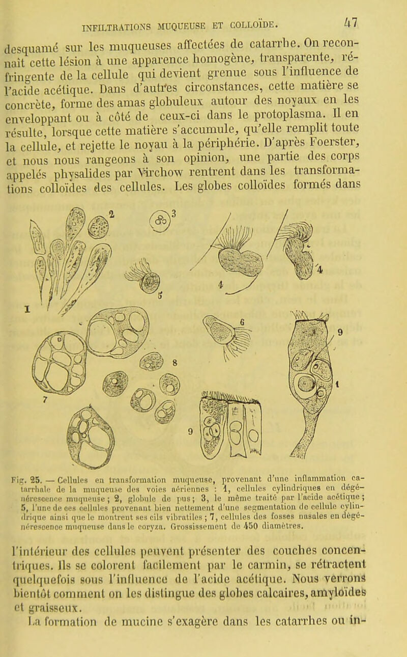 desquamé sur les muqueuses caffeclées de catarrlic. On recon- naît cette lésion à une apparence homogène, transparente, ré- frino-ente de la cellule qui devient grenue sous l'influence de l'acide acétique. Dans d'autres circonstances, cette matière se concrète, forme des amas globuleux autour des noyaux en les enveloppant ou à côté de ceux-ci dans le protoplasma. Il en résulte, lorsque cette matière s'accumule, qu'elle remplit toute la cellule, et rejette le noyau à la périphérie. D'après Foerster, et nous nous rangeons à son opinion, une partie des corps appelés physalides par Yirchow rentrent dans les transforma- tions colloïdes des cellules. Les globes colloïdes formés dans Fig. 25. — Cellules en transformation miitineuse, provenant d'une inflammation ca- larrliale de la muqueuse des voies aériennes ; i, cellules cylindriques en dégé- nérescence muqueuse; 2, globule do pus; 3, le même traité par l'acide acétique; 5, l'une de ces cellules provenant bien nettement d'une sesmentation de cellule cylin- rlrique ainsi que le montrent ses cils vibraliles ; 7, cellules dos fosses nasales en dégé- néresoenoe muqnense dans le coryza. Grossissement <le 450 diamètres. l'intérieur des cellules peuvent présenter des couches concen- triques. Ils se colorent facilement par le carmin, se rétractent quelquefois sous l'infhience de l'acide acétique. Nous verrons bientôt comment on les dislingue des glolies calcaires, amyloïdes et graisseux. I.a formation de mucine s'exagère dans les catarrhes ou in-