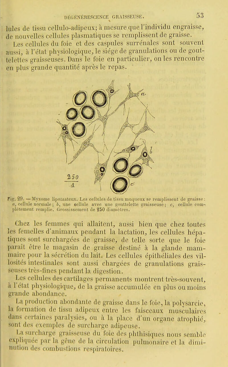 lules de lissu cellulo-adipeux; à mesure que l'individu engraisse, de nouvelles cellules plasmatiques se remplissent de graisse. Les cellules du foie et des caspules surrénales sont souvent aussi, à l'état physiologique, le siège de granulations ou de gout- telettes graisseuses. Dans le foie en particulier, on les rencontre en plus grande quantité après le repas. n, nellule normale ; 6, nne cellule avec une gouttelette graisseuse ; e, cellule eom- jilétement remplie, flrossissement de 250 diamètres. Chez les femmes qui allaitent, aussi bien que chez toutes les femelles d'animaux pendant la lactation, les cellules hépa- tiques sont surchargées de graisse, de telle sorte que le foie paraît être le magasin de graisse destiné à la glande mam- maire pour la sécrétion du lait. Les cellules épithéliales des vil- lositcs intestinales sont aussi chargées de granulations grais- seuses très-fines pendant la digestion. Les cellules des cartilages permanents montrent très-souvent, à l'état physiologique, de la graisse accumulée en plus ou moins gi'ande abondance. La production abondante de gi-aisse dans le foie, la polysarcie, la formation de tissu adipeu.x: entre les faisceaux musculaii'es dans certaines paralysies, ou à la ])lace d'un organe atrophié, sont des exemples de surcharge adipeuse. La surcharge graisseuse du foie des phlhisiques nous semble expliquée par la gime de la circiilalion |)iilnionaire el la dimi- nution des combusliniis l'espii'aloires.