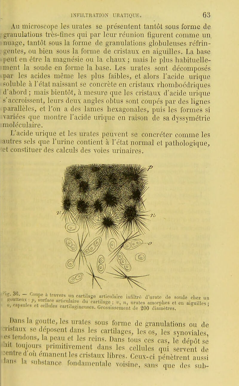 Au microscope les uvates se présentent tantôt sous forme de ; gi'anulations très-fines qui par leur réunion figurent comme un, 1 nuage, tantôt sous la forme de granulations globuleuses réfrin- , gentes, ou bien sous la forme de cristaux en aiguilles. La base |)eul en cMro la magnésie ou la chaux ; mais le plus habituelle- ment la soude en forme la base. Les urales sont décomposés par les acides même les plus faibles, et alors l'acide urique soluble à l'état naissant se concrète en cristaux rhomboédriques d'abord ; mais bientôt, à mesure que les cristaux d'acide urique s'accroissent, leurs deux angles obtus sont coupés par des lignes pai-allèles, et l'on a des lames hexagonales, puis les formes si variées que montre l'acide urique en raison de sa dyssymétrie moléculaire. L'acide urique et les urates peuvent se concréter comme les autres sels que l'urine contient à l'état normal et pathologique, et constituer des calculs des voies urinaires. «.mt^nv ,? Tl? . V ''a-e articlaire indUn'. d'iirate de sonde chez „n ■ ni^i;r IT '1 '•'•tilnse ; v, n, ni-ntes amorphes et en aiguilles- . 0, capsules et eellules oartMogineuses. Grossissement de 200 diaméfes. ^ Dans la goutte, les urates sous forme de granulations ou do :nstaux se déposent dans les cartilages, les os, les synoviales, • es tendons, la peau et les reins. Dans tous ces cas, le dépôt se ^ail toujours i)rimitivement dans les cellules qui servent do centre don émanent les cristaux libres. Ceux-ci pénèirent aussi lans la substance fondamentale voisine, sans que des sub-