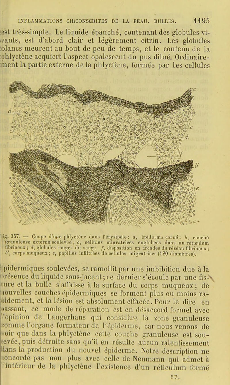 îsst très-simple. Le liquide épanché, contenant des globules vi- f/ants, est d'abord clair et légèreuient citrin. Les globules [olancs meurent au bout de peu de temps, et le contenu de la ublyctène acquiert l'aspect opalescent du pus dilué. Ordinaire- ment la partie externe de la phlyctène, formée par les cellules 'lig. 357.— Coupe d'iuie pUlyctène ilaiii l'érysipéle: o, 6p'ulennj corne'; b, couche ■fn-anuleuse externe soulevée ; c, cellules migratrices engldbùes dans uu roticulnm fibrineux ; d, globules rouges du sang ; f, disposition en arcades du résùau fdirinoux ; b', corps muqneux; e, papilles infiltrées de cellules migratrices (120 diamètres). [ipidermiques soulevées, se ramollit par une imbibition due à la irésence du liquide sous-jacent; ce dernier s'écoule par une fis-\ lure et la bulle s'affaisse à la surface du corps muqueux; de nouvelles couches épidermiques se forment plus ou moins ra- ■Didement, et la lésion est absolument effacée. Pour le dire en •lassant, ce mode de réparation est en désaccord formel avec opinion de Laugerhans qui considère la zone granuleuse oomme l'organe formateur de l'épidcrme, car nous venons de 'oir que dans la phlyctène cette couche granuleuse est sou- levée, puis détruite sans qu'il en résulte aucun ralentissement Uans la production du nouvel épidémie. Notre description ne .oncorde pas non plus avec celle de Neumann qui admet h 'intérieur de la phlyclène l'existence d'un réticulura formé C7,