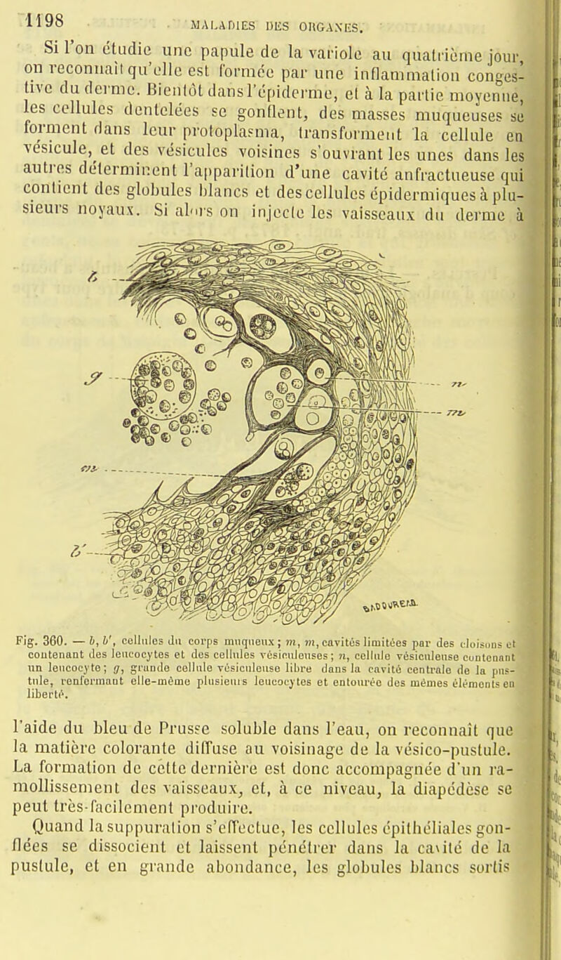 ^^^8 MALADIES 1)I£S OUGANF.S. Si l'on étudie une papule de la variole au quatrième jour, on reconnaît qu'elle est formée par une innammalion conges- tivc du derme. Bieulôt dansl'épiderme, el à la partie moyenne, les cellules dentelées se gonflent, des masses muqueuses se lorment dans leur protoplasma, transforment la cellule ea vésicule, et des vésicules voisines s'ouvrant les unes dans les autres déterminent ra|)parilion d'une cavité anfractueuse qui contient des globules blancs et des cellules épidermiques à plu- sieurs noyaux. Si alors on injecle les vaisseaux du derme à I Fig. 360. — b, b', cellules du corps nmqneux; )?!, m, cavités limitées par des clois(]Us et coutenant des leucocytes et des cellules vésleulouses ; n, cellule résiculeuse cuntcnniit un leucocyte; g, grande cellule vésiculouse libre dans la cavité centrale de la pus- tule, ronlormant elle-même plusieuis leucocytes et entourée des mêmes éléments en liberté. l'aide du bleu de Prusse soluble dans l'eau, on reconnaît que la matière colorante diffuse au voisinage de la vésico-pustule. La formation de cette dernière est donc accompagnée d'un ra- mollissement des vaisseaux^ et, à ce niveau, la diapédèse se peut très-facilement produire. Quand la suppuration s'effectue, les cellules épithéliales gon- flées se dissocient et laissent pénétrer dans la ca\ité de la pustule, et en grande abondance, les globules blancs sortis