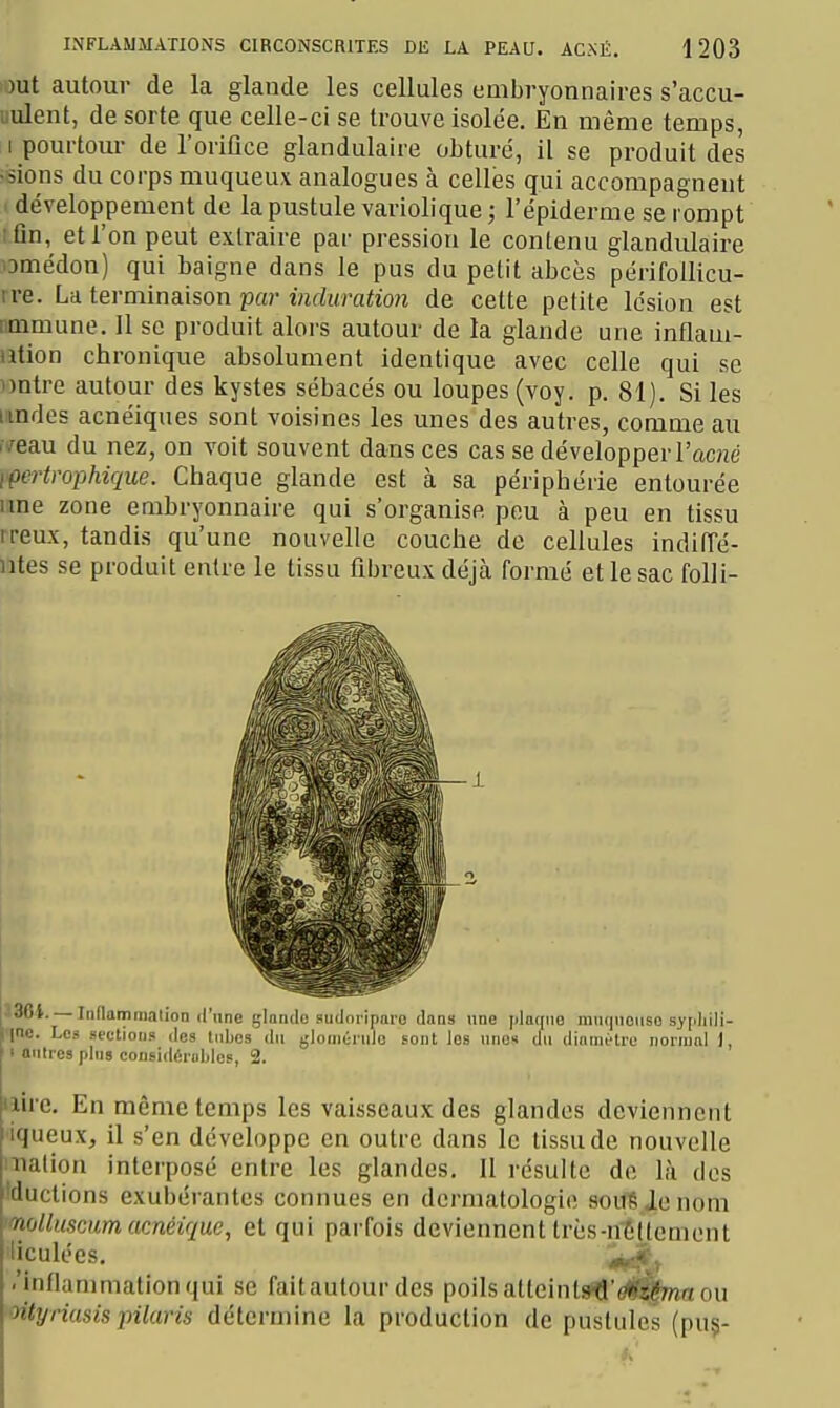 lout autour de la glande les cellules embryonnaires s'accu- uulent, de sorte que celle-ci se trouve isolée. En même temps, I pourtour de l'oriOce glandulaire obturé, il se produit des •sions du corps muqueu\ analogues à celles qui accompagnent développement de la pustule variolique ; l'épideraie se rompt :Qn, et l'on peut extraire par pression le contenu glandulaire omédon) qui baigne dans le pus du petit abcès périfoUicu- ire. La terminaison par induration de cette petite lésion est immune. Il se produit alors autour de la glande une inflam- ation chronique absolument identique avec celle qui se Dntre autour des kystes sébacés ou loupes (voy. p. 81). Si les imdes acnéiques sont voisines les unes des autres, comme au i/eau du nez, on voit souvent dans ces cas se développer l'acné ipertrophique. Chaque glande est à sa périphérie entourée une zone embryonnaire qui s'organise peu à peu en tissu rreux, tandis qu'une nouvelle couche de cellules indiiïé- ntes se produit entre le tissu fibreux déjà formé et le sac folli- 336i. Iiiflammation (l'une glande sudoriparo dans une [ilatine mn(|nonso sypliili- nnc. Les section» des liiLes du glonninilo sont les une» du dinmi-tro normal J, 1 antres pins considéroldes, 2. iiire. En même temps les vaisseaux des glandes deviennent iqueux, il s'en développe en outre dans le tissu de nouvelle lualion interposé entre les glandes. Il résulte de là dos 'ductions exubérantes connues en dermatologie souSienom l'uscumacnéique, et qui parfois deviennent Irès-ntttement iculées. ^ft^r .'inflammationqui se faitautourdes poilsatteintaitt'âS^waou oityriasis pilaris détermine la production de pustules (pu§-