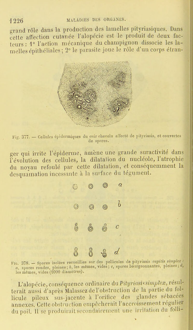 <yv&x\d rôle dans la production des lamelles pityriasiques. Dans cette affection cutanée l'alopécie est le produit de deux fac- teurs : 1° l'action mécanique du champignon dissocie les la- melles épiihéliales ; 2° le parasite joue le rôle d'un corps élran- Fi. 377. Celliilos épiclei'miques du cuir chevelu affecté do pityriasis, et courertcs de spores. ger qui irrite l'épiderme, amène une grande suractivité dans l'évolution des cellules, la dilatation du nucléole, l'atrophie du noyau refoulé par cette dilatation, et conséquemment la desquamation incessante à la surface du tégument. G @ ® « @ @ @ l'iG 378 — Spores isolées recueillies sur des pellicules de pityriasis cajnlis simplex : a, spores rondes, pleines; b, les mêmes, rides; c, spores bourgeonnantes, pleines;<i, les mêmes, vides (1000 diamètres). L'alopécie, conséquence ordinaire daPityriasi-isimplex, résul- terait aussi d'après Malassez de l'obslrucliou do la partie du fol- licule pileux sus-jacente à l'oritice des glandes sébacées annexes. Cette obstruction empêcherait l'accroissement régulier du poil. 11 se produirait secondaireiiicnl une irrilalion du folli-