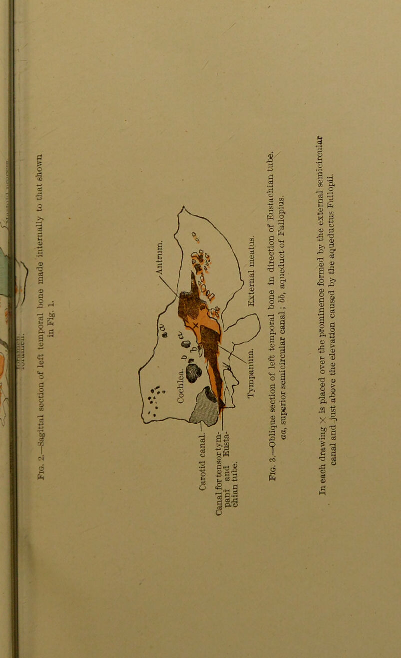 Fig. 2.—Sagittal section of left temporal bone made internally to that shown in Fig. 1. In each drawing X is placed over the prominence formed by the external semicircular canal and just above the elevation caused by the aqueductus Fallopii.
