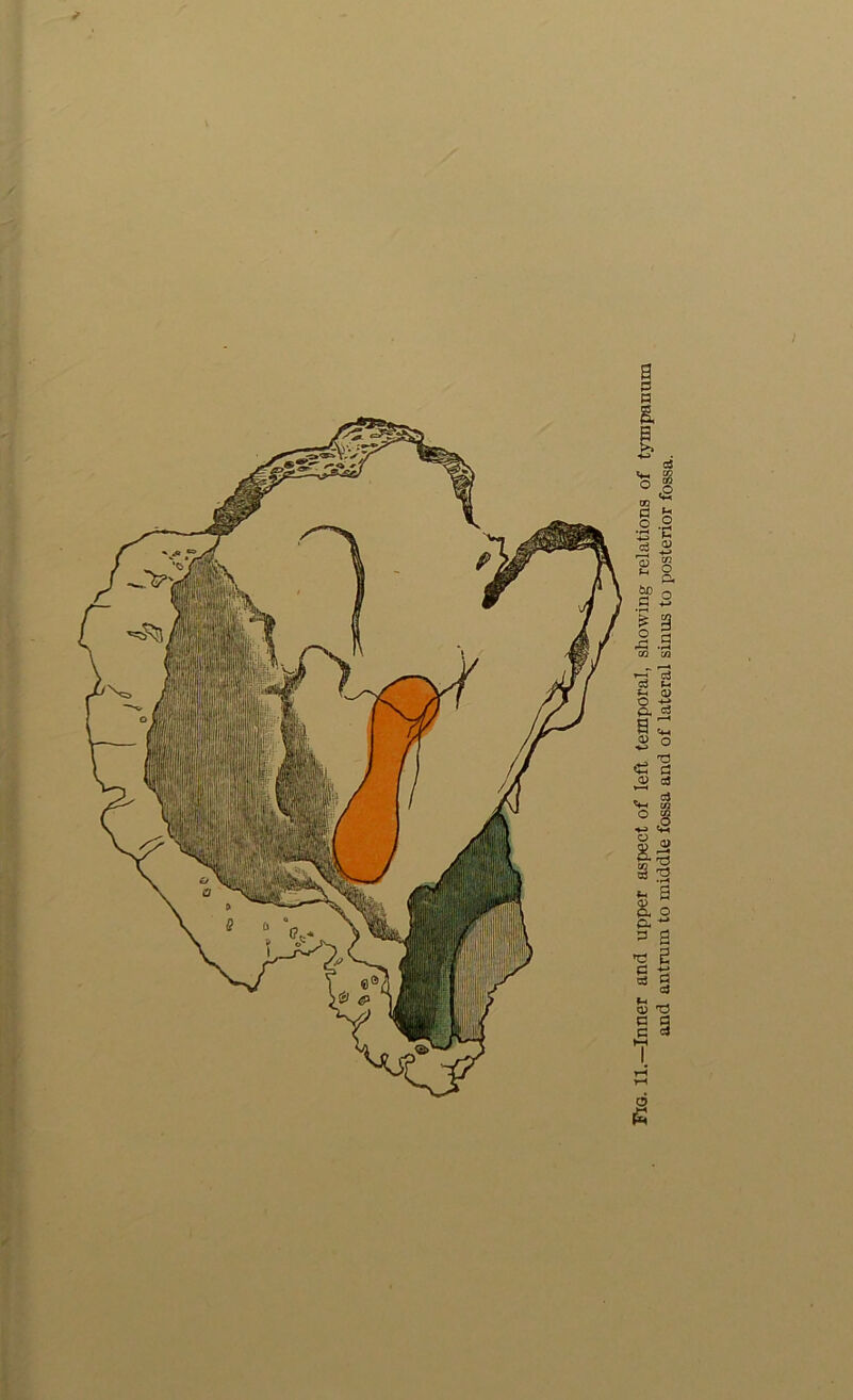 and antrum to middle fossa and of lateral sinus to posterior fossa.