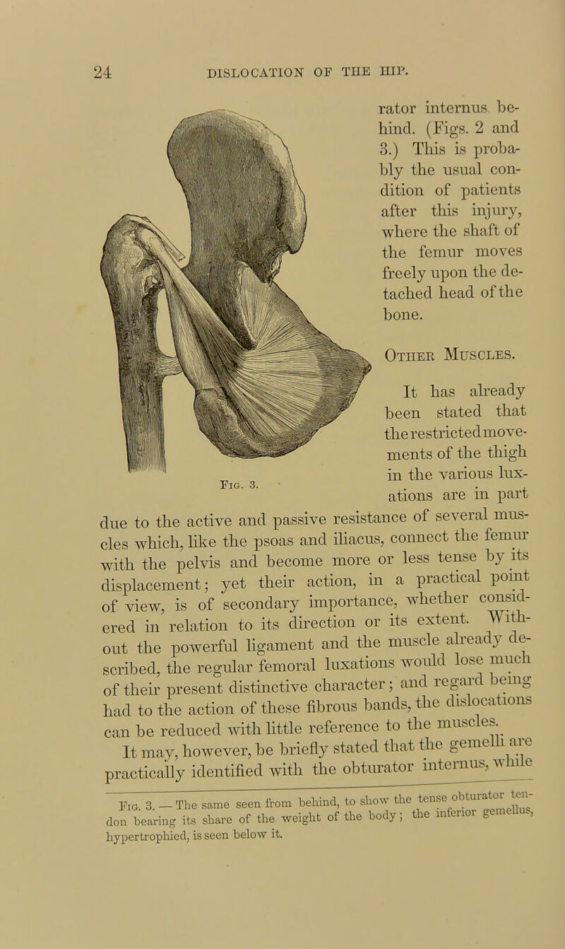 rator internus be- hind. (Figs. 2 and 3.) This is proba- bly the usual con- dition of patients after this injury, where the shaft of the femur moves freely upon the de- tached head of the bone. Other Muscles. It has already been stated that the restrictedmove- ments of the thigh in the various lux- ations are in part due to the active and passive resistance of several mus- cles which, Hke the psoas and ihacus, connect the femur with the pelvis and become more or less tense by its displacement; yet their action, in a practical pouit of view, is of secondary importance, whether consid- ered in relation to its direction or its extent. With- out the powerful hgament and the muscle already de- scribed, the regular femoral luxations would lose much of their present distinctive character; and regard being had to the action of these fibrous bands, the dislocations can be reduced with little reference to the muscles It may, however, be briefly stated that the gemelh are practicaUy identified with the obturator internus, wlule Fig. 3. - The same seen from behind, to show the t^^:^'^*'^^ don bearing its share of the ^veight of the body; tl:e mfenor gemeUus, hypertrophied, is seen below it.