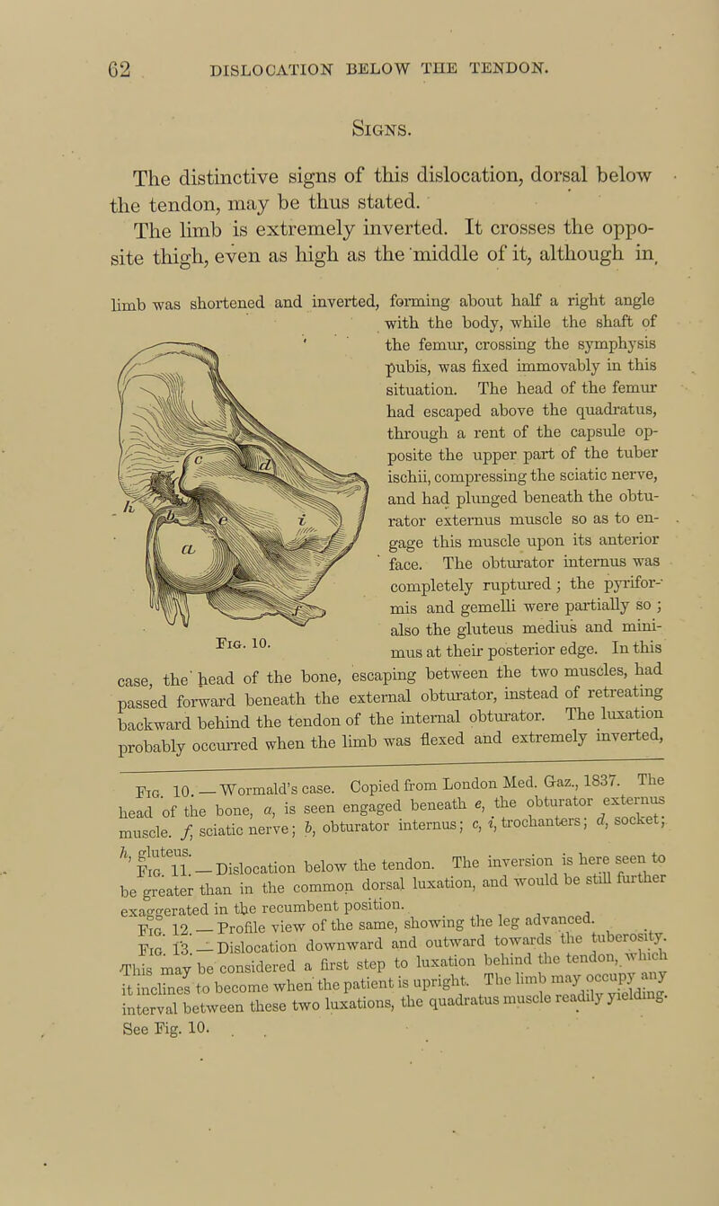 Signs. The distinctive signs of this dislocation, dorsal below the tendon, may be thus stated. The limb is extremely inverted. It crosses the oppo- site thigh, even as high as the middle of it, although in, limb -was shortened and inverted, forming about half a right angle with the body, while the shaft of the femur, crossing the symphysis pubis, was fixed immovably in this situation. The head of the femur had escaped above the quadi-atus, through a rent of the capsule op- posite the upper part of the tuber ischii, compressing the sciatic nerve, and had plunged beneath the obtu- rator externus muscle so as to en- gage this muscle upon its anterior face. The obturator intemus was completely ruptured 3 the pyiifor- mis and gemelh were pailially so ; also the gluteus medius and mini- mus at their posterior edge. In this case the head of the bone, escaping between the two muscles, had passed forward beneath the external obturator, instead of retreatmg backward behind the tendon of the internal obtui-ator. The luxation probably occurred when the limb was flexed and extremely mverted. Fig. 10. I'lG 10 _ Wormald's case. Copied from London Med. Qaz., 1837. The head of the bone, a, is seen engaged beneath e, the f muscle, f, sciatic nerve; b, obturator intemus; c, trochanters; d, socket, h, gluteus. ^ ^.^^^^^^.^^ ^^^^^ The inversion is here seen to be greater than in the common dorsal luxation, and would be still further exaggerated in the recumbent position. , , , ^ Y°a 12 - Profile view of the same, showing the leg advanced 13-Dislocation downward and outward towards the tuberosity ^Js may be considered a first step to luxation behind the tendon,.win h fttlfnel to become when the patient is upright. The ^^^J^^^^ interval between these two luxations, the quadratus muscle readily yielding. See rig. 10. . .