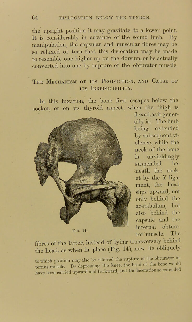 the upright position it may gravitate to a lower point. It is considerably in advance of the sound limb. By manipulation, the capsular and muscular fibres may be so relaxed or torn that this dislocation may be made to resemble one higher up on the dorsum, or be actually converted into one by rupture of the obturator muscle. The Mechanism of its Production, and Cause of ITS Ireeducibility. In this luxation, the bone first escapes below the socket, or on its thyroid aspect, when the thigh is flexed,as it gener- ally is. Thehmb being extended by subsequent vi- olence, while the neck of the bone is unyieldingly suspended be- neath the sock- et by the Y hga- ment, the head sHps upward, not only beliind the acetabulum, but also beliind the capsule and the internal obtura- tor muscle. The fibres of the latter, instead of lying transversely behind the head, as when in place (Fig. 14), now lie obHquely to which position may also be referred the rupture of the obtimitor in- temus muscle. By depressing the knee, the head of the bone would have been carried upward and backward, and the laceration so extended