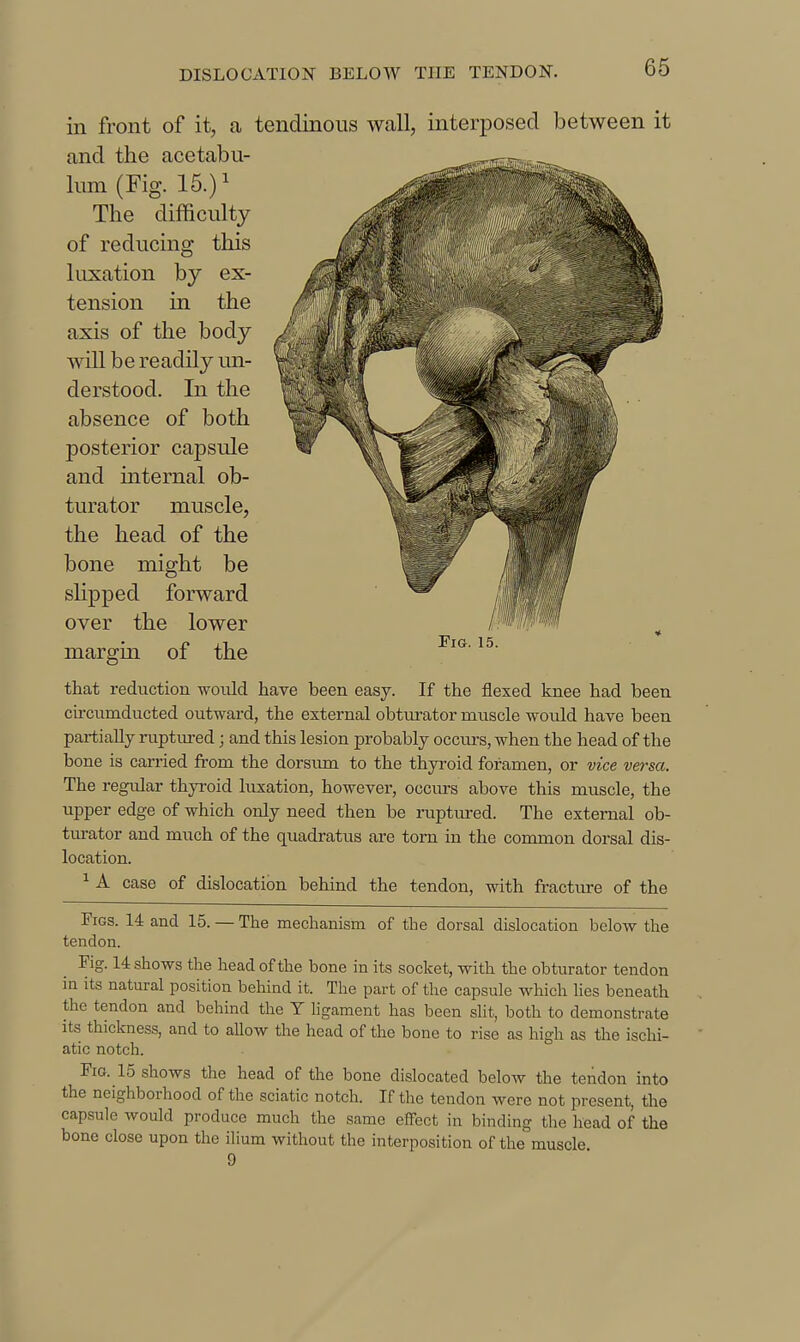 in front of it, a tendinous wall, interposed between it and the acetabu- lum (Fig. 15.)^ The difficulty of reducing this luxation by ex- tension in the axis of the body will be readily im- derstood. In the absence of both posterior capsule and internal ob- turator muscle, the head of the bone might be shpped forward over the lower margin of the that reduction would have been easy. If the flexed knee had been circumducted outward, the external obtui-ator muscle would have been partially ruptured; and this lesion probably occurs, when the head of the bone is carried from the dorsum to the thyroid foramen, or vice versa. The regular thyroid luxation, however, occurs above this muscle, the vipper edge of which only need then be ruptiu-ed. The external ob- turator and much of the quadratus are torn in the common dorsal dis- location. ^ A case of dislocation behind the tendon, with fractm-e of the Figs. 14 and 15. — The mechanism of the dorsal dislocation below the tendon. Fig. 14 shows the head of the bone in its socket, with the obturator tendon in its natural position behind it. The part of the capsule which Ues beneath the tendon and behind the Y hgament has been slit, both to demonstrate its thickness, and to allow the head of the bone to rise as high as the ischi- atic notch. Fig. 15 shows the head of the bone dislocated below the tendon into the neighborhood of the sciatic notch. If the tendon were not present, the capsule would produce much the same effect in binding the head of the bone close upon the ilium without the interposition of the muscle 9