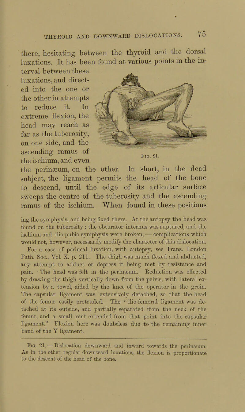 Fig. 21. there, hesitating between the thyroid and the dorsal luxations. It has been found at various pomts in the in- terval between these luxations, and direct- ed into the one or the other in attempts to reduce it. In extreme flexion, the head may reach as far as the tuberosity, on one side, and the ascending ramus of the ischium, and even the perinsBum, on the other. In short, in the dead subject, the hgament permits the head of the bone to descend, until the edge of its articular surface sweeps the centre of the tuberosity and the ascending ramus of the ischium. When found in these positions ing the symphysis, and being fixed there. At the aiitopsy the head was found on the tuberosity ; the obturator internus was ruptm-ed, and the ischium and iho-pubic symphysis were broken, — comphcations which would not, however, necessarily modify the character of this dislocation. For a case of perineal luxation, with autopsy, see Trans. London Path. Soc, Vol. X. p. 211. The thigh was much flexed and abducted, any attempt to adduct or depress it being met by resistance and pain. The head was felt in the perinEeum. Reduction was effected by drawing the thigh vertically down from the pelvis, with lateral ex- tension by a towel, aided by the knee of the operator in the gToin. The capsular ligament was extensively detached, so that the head of the femtir easily protruded. The  ilio-femoral ligament was de- tached at its outside, and partially separated from the neck of the femur, and a small rent extended from that point into the capsular ligament. Flexion here was doubtless due to the remaining inner band of the Y ligament. Fig. 21. — Dislocation downward and inward towards the perinreum. As in the other regular downward luxations, the flexion is proportionate to the descent of the head of the bone.