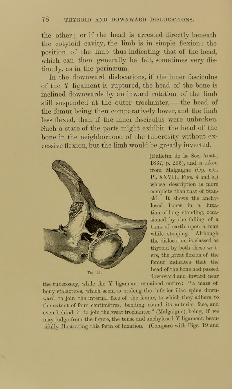 the other; or if the head is arrested directly beneath the cotyloid cavity, the limb is in simple flexion: the position of the Ihnb thus indicating that of the head, which can then generally be felt, sometimes very dis- tinctly, as in the perina3um. In the downward dislocations, if the inner fasciculus of the Y ligament is ruptured, the head of the bone is inclined downwards by an inward rotation of the limb still suspended at the outer trochanter, — the head of the femur being then comparatively lower, and the hmb less flexed, than if the inner fasciculus were unbroken. Such a state of the parts might exhibit the head of the bone in the neighborhood of the tuberosity without ex- cessive flexion, but the Hmb would be greatly inverted. (Bulletin de la Soc. Anat., 1837, p. 296), and is taken from Malgaigne (Op. cit., PI. XXVII., Figs. 4 and 5,) whose description is more complete than that of Stan- ski. It shows the anchy- losed bones in a luxa- tion of long standing, occa- sioned by the falling of a bank of earth upon a man while stooping. Although the dislocation is classed as thyroid by both these writ- ers, the great flexion of the femiu* indicates that the head of the bone had passed downward and inward near the tuberosity, while the Y ligament remained entire: a mass of bony stalactites, which seem to prolong the inferior iliac spine down- ward to join the intenial face of the femm-, to which they adhere to the extent of fom- centimetres, bending round its anterior face, and even behind it, to join the great trochanter  (Malgaigne), being, if we may judge from the figure, the tense and anchylosed Y ligament, beau- tifully illustrating this form of luxation. (Compare with Figs. 19 and