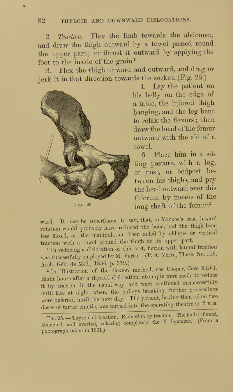 2. and the foot 3. jerk Traction. Flex the limb towards the abdomen, draw the thigh outward by a towel passed round upper part; or thrust it outward by applying the to the inside of the groin.^ Flex the thigh upward and outward, and drag or it in that direction towards the socket. (Fig. 25.) 4. Lay the patient on his belly on the edge of a table, the injured thigh hanging, and the leg bent to relax the flexors; then draw the head of the femur outward with the aid of a towel. 5. Place him in a sit- ting posture, with a log, or post, or bedpost be- tween his thighs, and pry the head outward over this fulcrum by means of the long shaft of the femm\^ ward It may be superfluous to say, that, in Markoe's case, inward rotation would probably have reduced the bone, had the thigh been less flexed, or the manipulation been aided by obhque or vertical traction with a towel around the thigh at its upper part. 1 In reducing a dislocation of this sort, flexion with lateral traction was successfully employed by M. Vertu. (P. A. Vertu, Th^se, No. 116, Arch. Gen. de Med., 1836, p. 379.) 2 In illustration of tbe flexion method, see Cooper, Case XL\ i. Eight hours after a thyroid dislocation, attempts were made to reduce it by traction in the usual way, and were continued unsuccessfully until late at night, when, the pulleys breaking, fiu-ther proceedings were deferred until the next day. The patient, having then taken two doses of tartar emetic, was carried into the operating theatre at 2 p. m. Fig 25 -Thyroid dislocation. Reduction by traction. The hmb is flexed, abducted, and everted, relaxing completely the Y ligament. (From a photograph taken in 1861.)