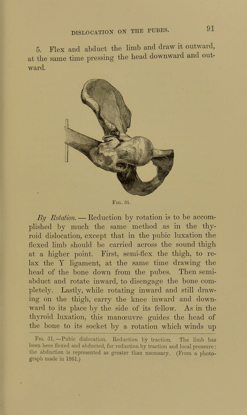 6. Flex and abduct the limb and draw it outward, Fig. 31. By Rotation. — Eednction by rotation is to be accom- plished by much the same method as in the thy- roid dislocation, except that in the pubic luxation the flexed limb should be carried across the sound thigh at a higher point. First, semi-flex the thigh, to re- lax the Y ligament, at the same time drawing the head of the bone down from the pubes. Then semi- abduct and rotate inward, to disengage the bone com- pletely. Lastly, while rotating inward and still draw- ing on the thigh, carry the knee inward and down- ward to its place by the side of its fellow. As in the thyroid luxation, this manoeuvre guides the head of the bone to its socket by a rotation which winds up Fig. 31.—Pubic dislocation. Reduction by traction. The limb has been here flexed and abducted, for reduction by traction and local pressure: tlie abduction is represented as greater than necessary. (From a photo- graph made in 1861.)