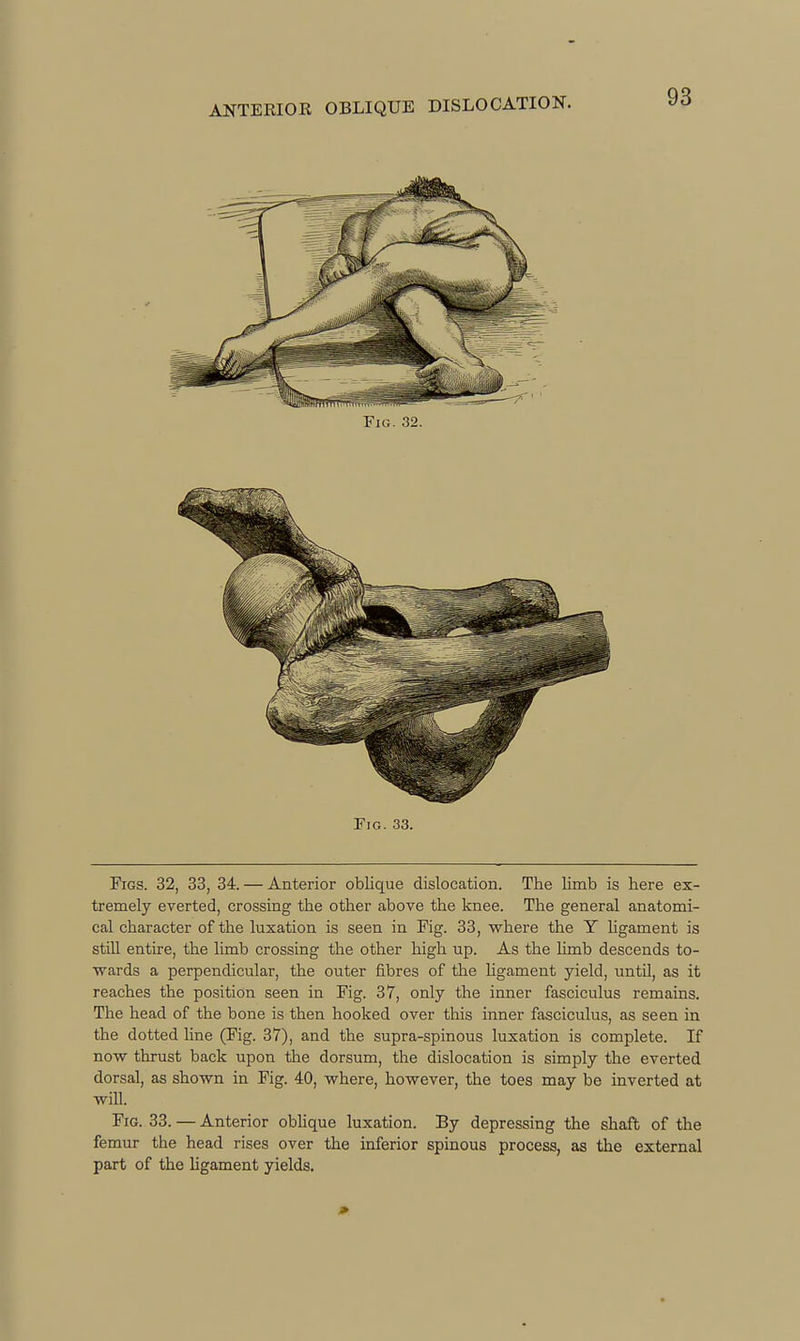 Fig. 33. Figs. 32, 33, 34. — Anterior oblique dislocation. The limb is here ex- tremely everted, crossing the other above the knee. The general anatomi- cal character of the luxation is seen in Fig. 33, where the Y hgament is still entire, the limb crossing the other high up. As the hmb descends to- wards a perpendicular, the outer fibres of the ligament yield, until, as it reaches the position seen in Fig. 37, only the inner fasciculus remains. The head of the bone is then hooked over this inner fasciculus, as seen in the dotted line (Fig. 37), and the supra-spinous luxation is complete. If now thrust back upon the dorsum, the dislocation is simply the everted dorsal, as shown in Fig. 40, where, however, the toes may be inverted at will. Fig. 33. — Anterior obhque luxation. By depressing the shaft of the femur the head rises over the inferior spinous process, as the external part of the hgament yields.