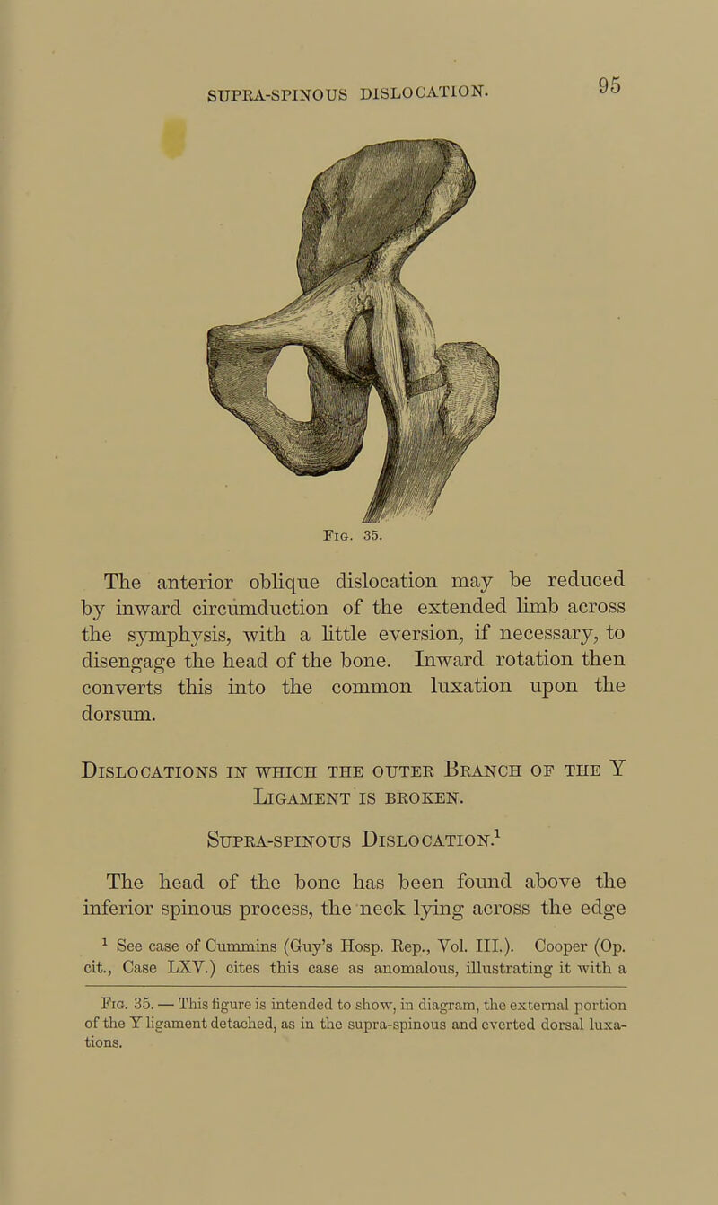 Fig. 35. The anterior oblique dislocation may be reduced by inward circumduction of the extended hmb across the S3nnphysis, with a httle eversion, if necessary, to disengage the head of the bone. Inward rotation then converts this into the common luxation upon the dorsum. Dislocations in which the outee Beanch of the Y Ligament IS beoken. SuPEA-spiNOus Dislocation.^ The head of the bone has been found above the inferior spinous process, the neck lying across the edge ^ See case of Cummins (Guy's Hosp. Rep., Vol. III.). Cooper (Op. cit., Case LXV.) cites this case as anomalous, illustrating it with a Fig. 35. — This figure is intended to show, in diagram, tlie external portion of the Y hgament detached, as in the supra-spinous and everted dorsal luxa- tions.